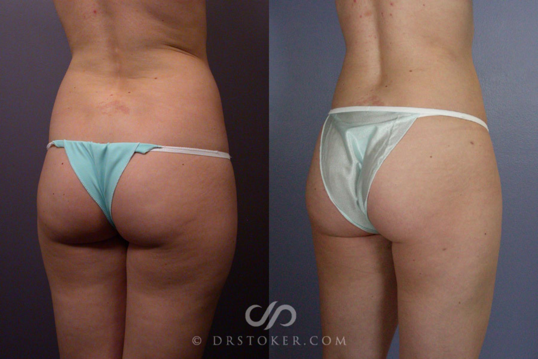Before & After Liposuction Case 166 View #8 View in Los Angeles, CA