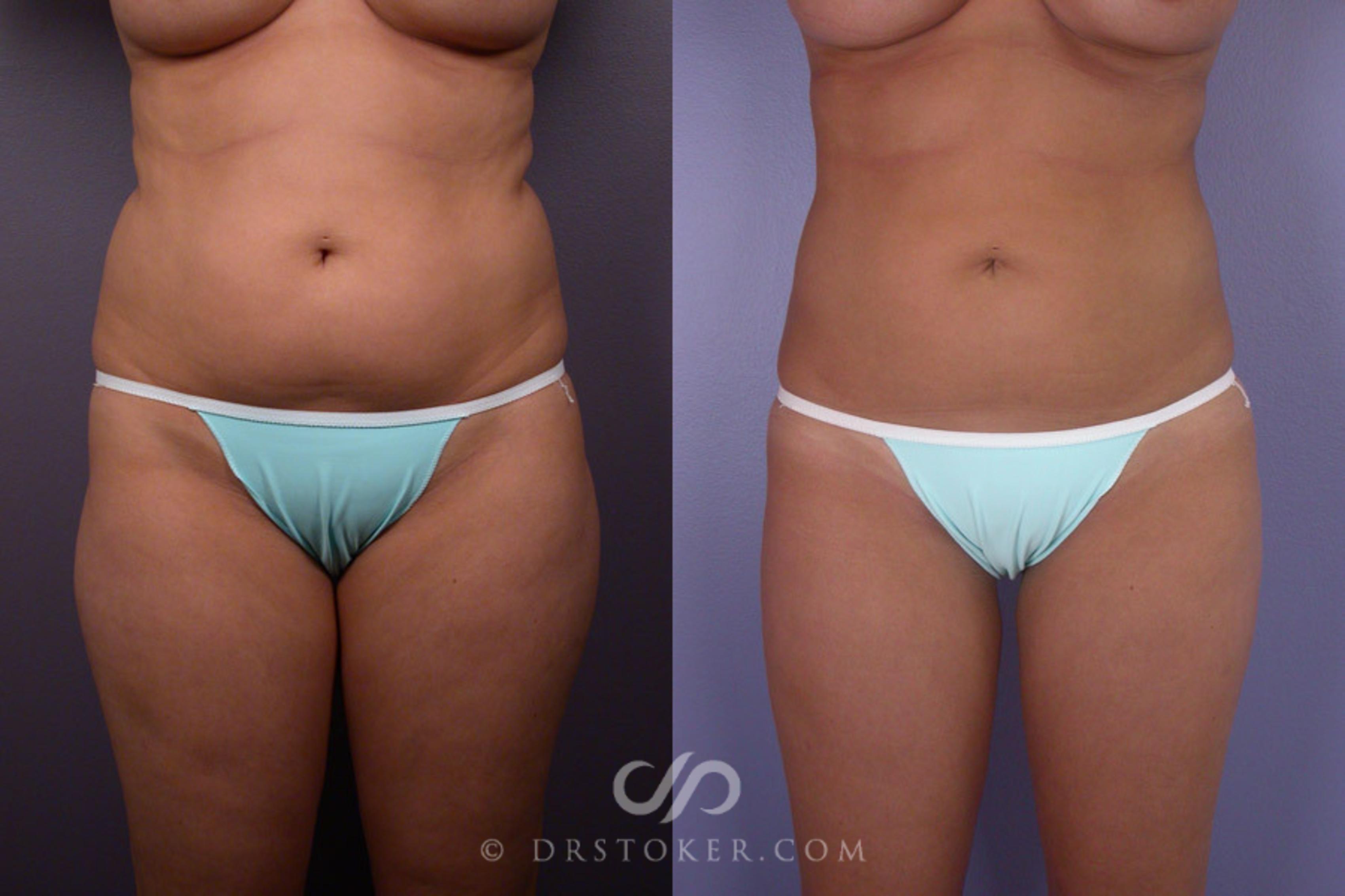 Before & After Liposuction Case 167 View #1 View in Los Angeles, CA