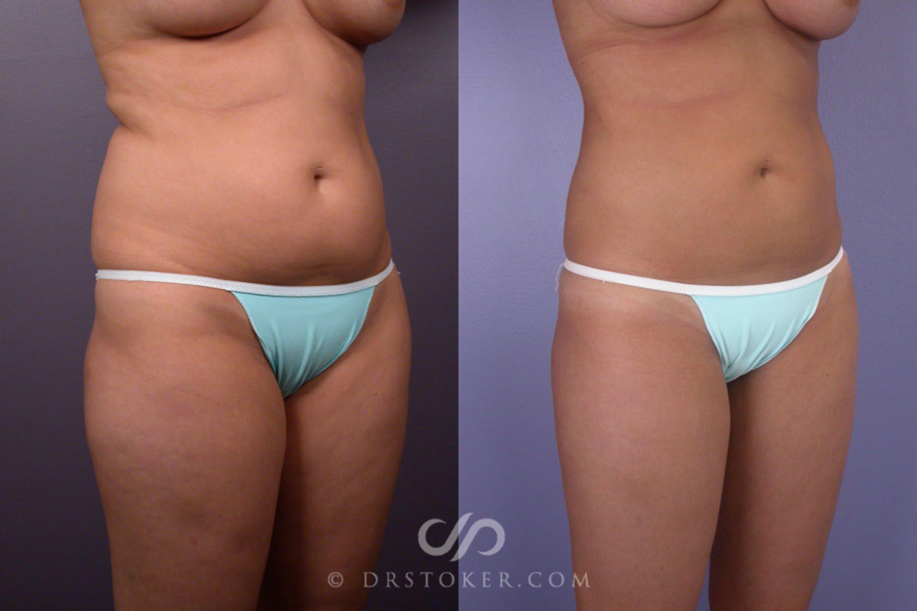 Before & After Liposuction Case 167 View #2 View in Los Angeles, CA