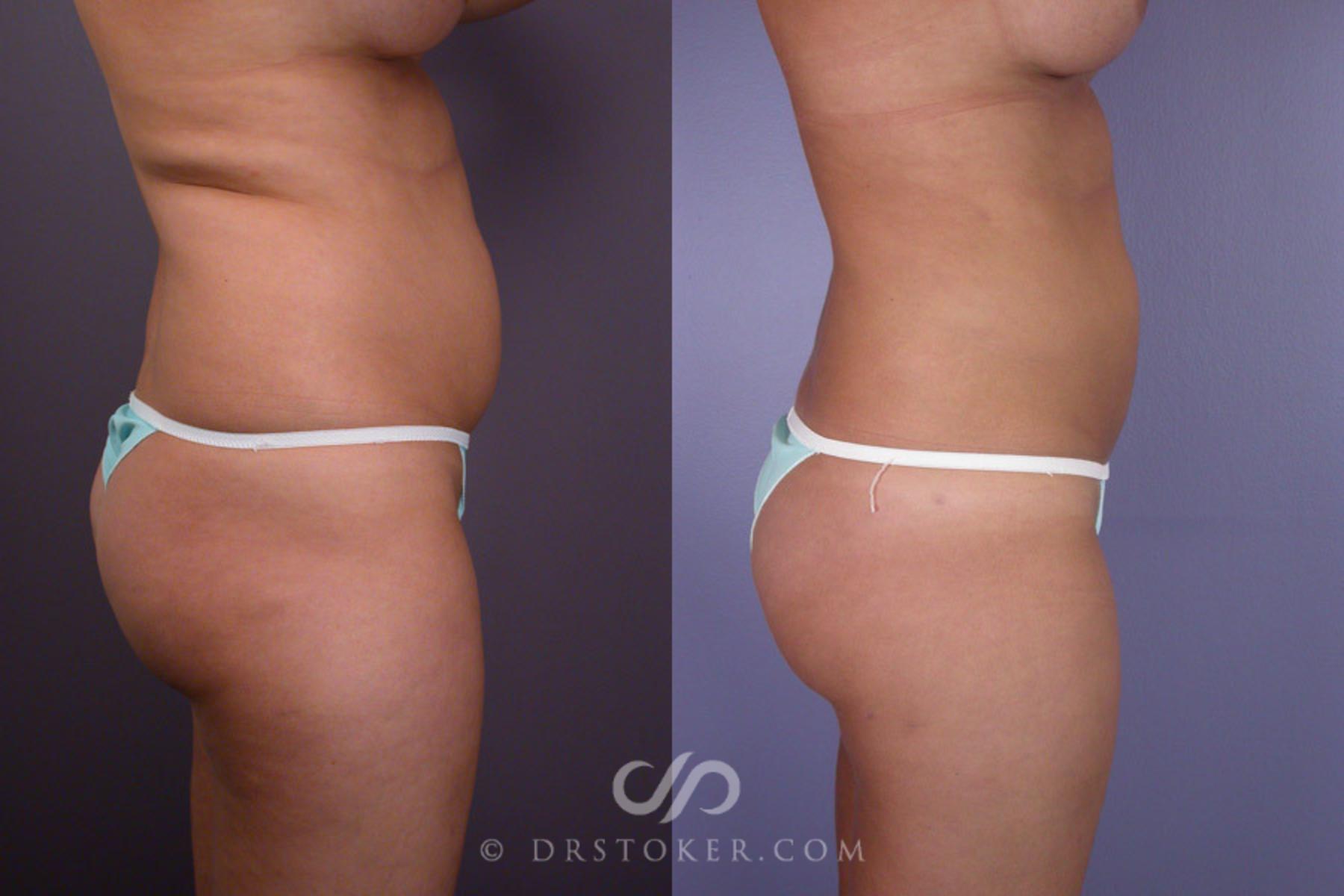 Before & After Liposuction Case 167 View #4 View in Los Angeles, CA