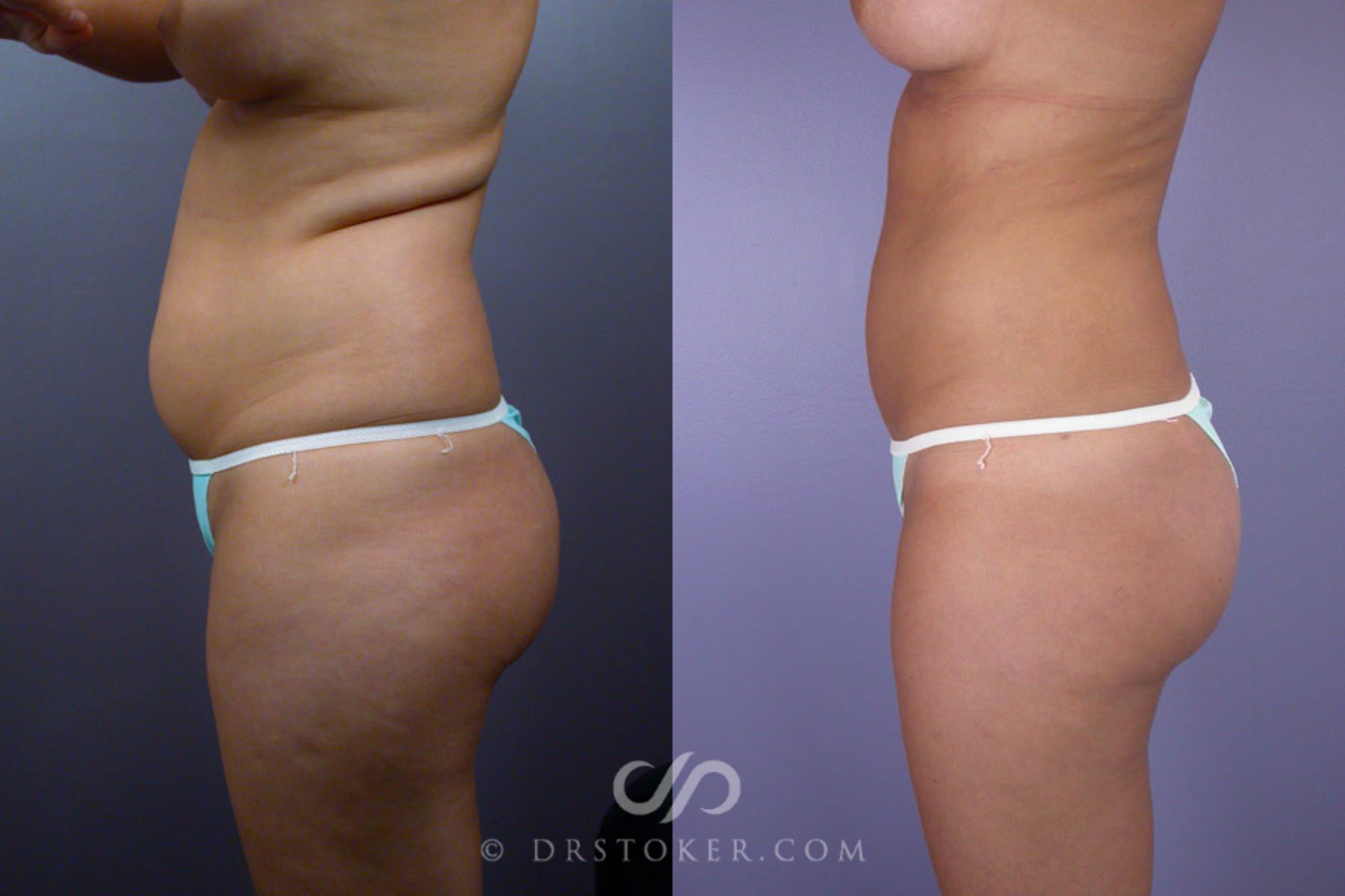 Before & After Liposuction Case 167 View #5 View in Los Angeles, CA