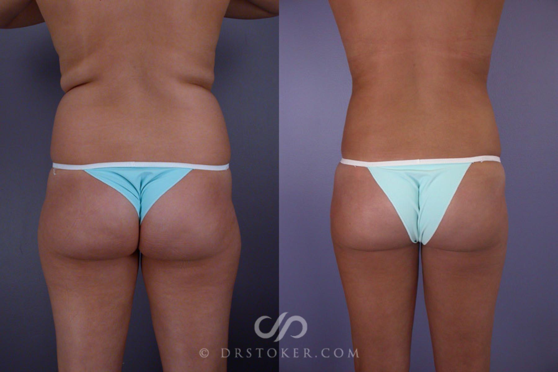 Before & After Liposuction Case 167 View #6 View in Los Angeles, CA