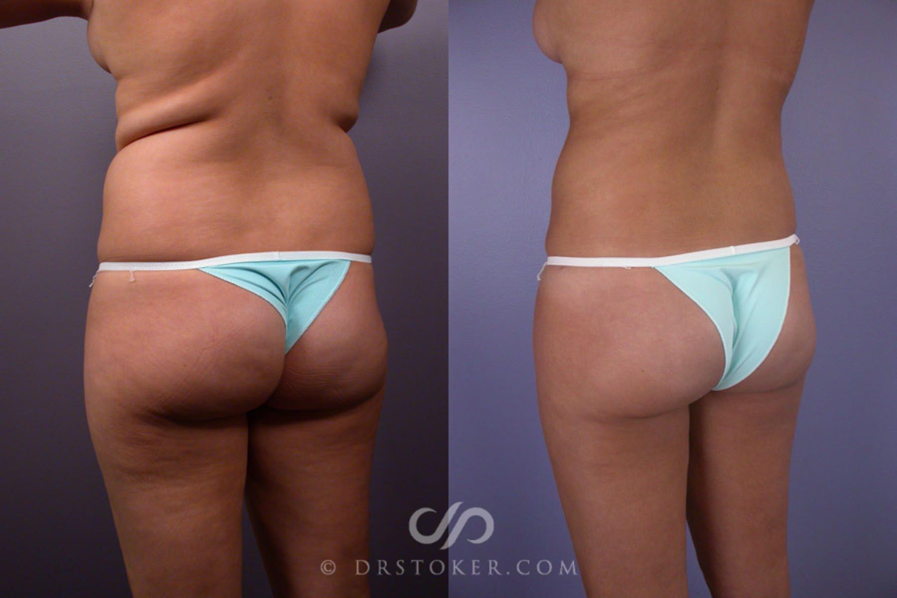Before & After Liposuction Case 167 View #7 View in Los Angeles, CA