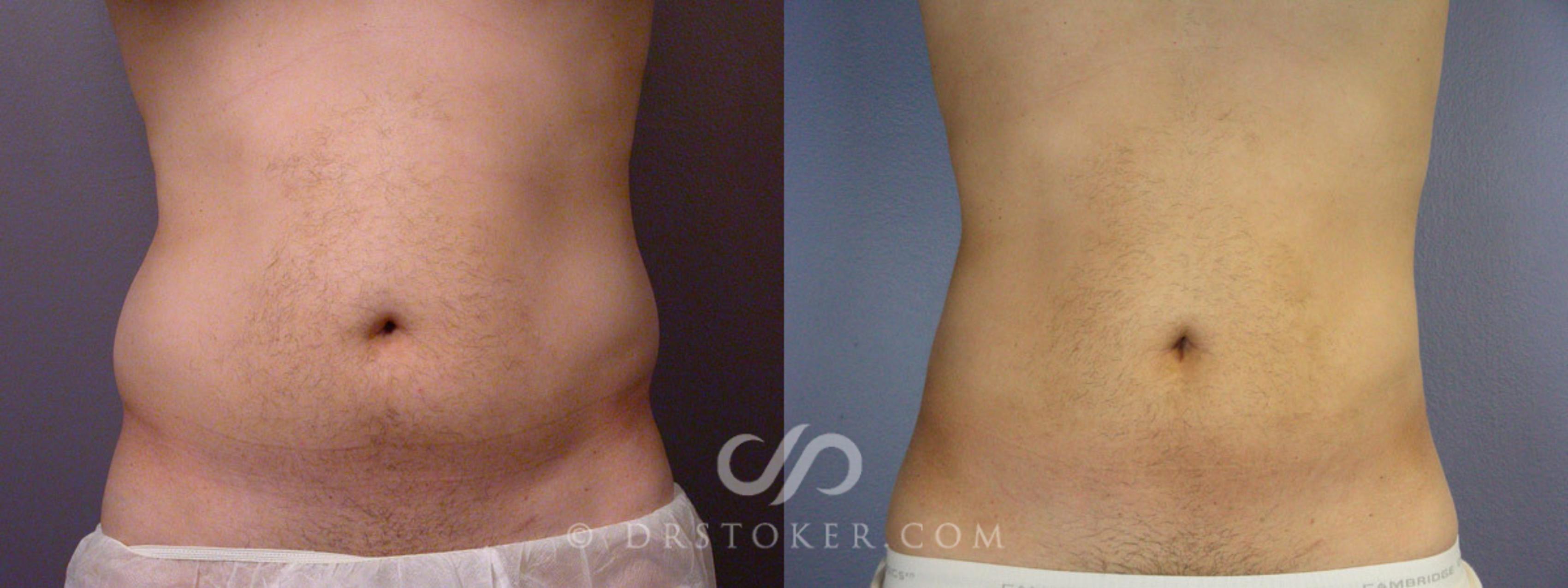 Before & After Liposuction for Men Case 168 View #1 View in Los Angeles, CA