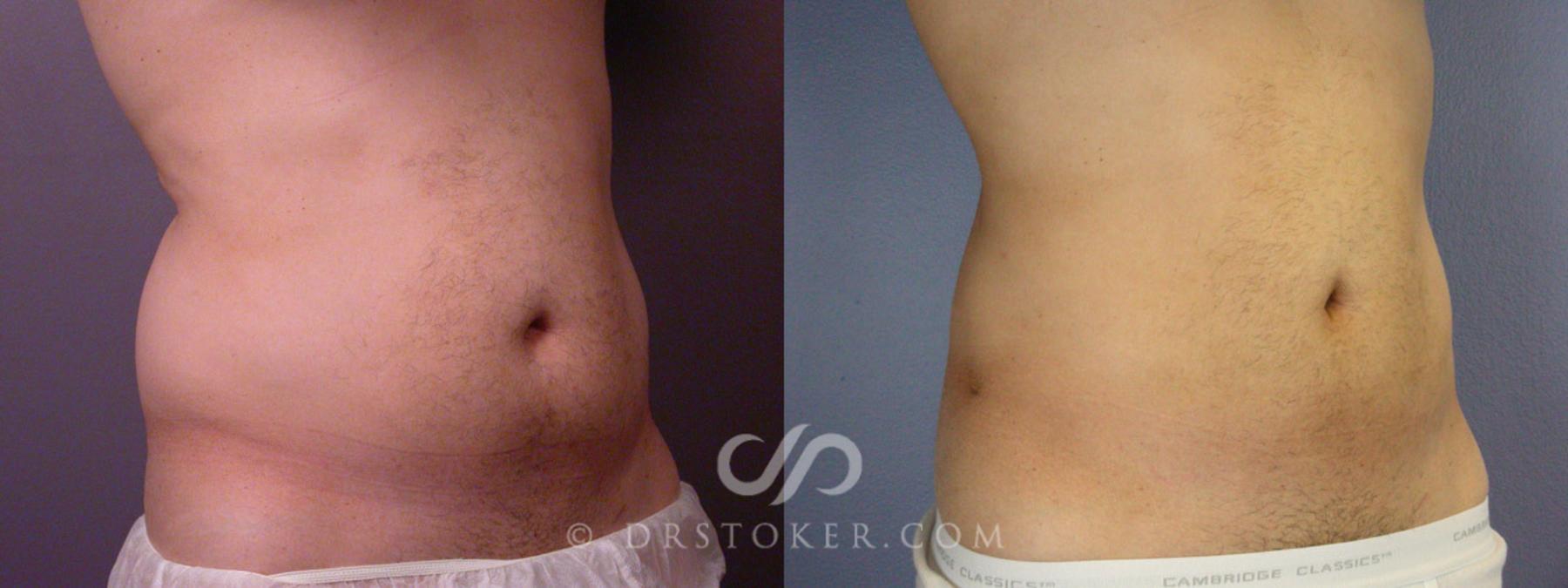 Before & After Liposuction for Men Case 168 View #2 View in Los Angeles, CA
