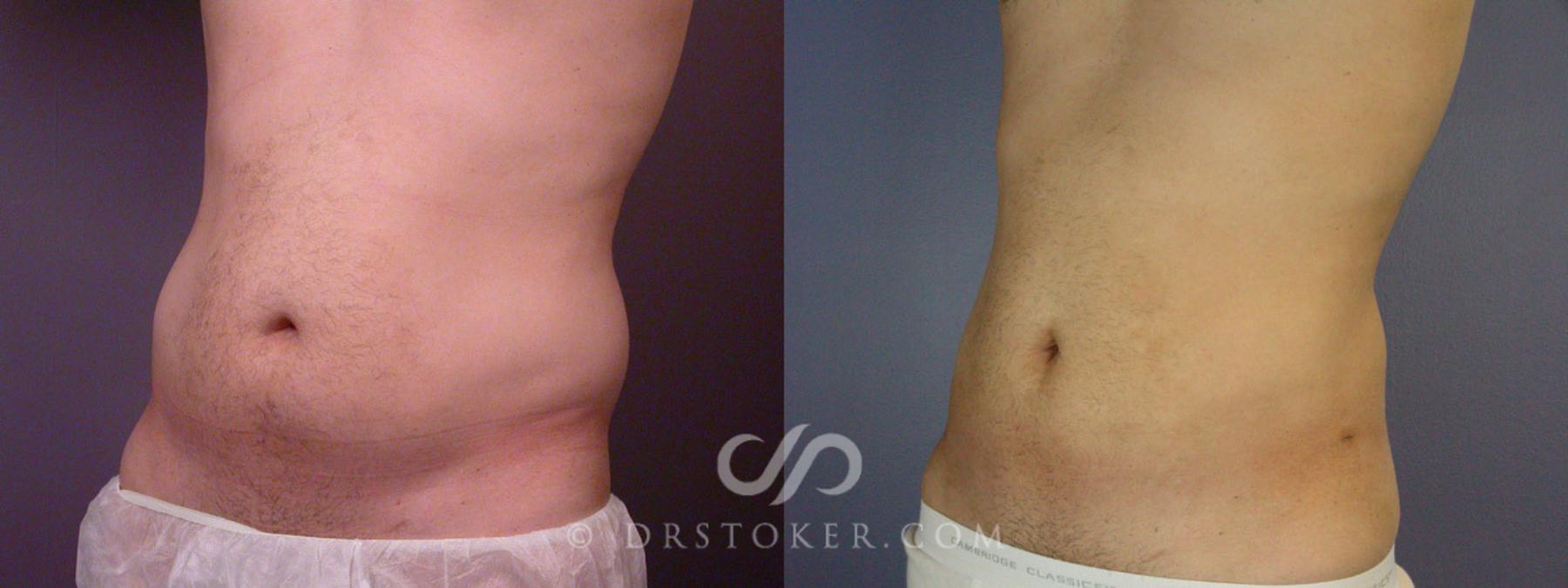 Before & After Liposuction for Men Case 168 View #3 View in Los Angeles, CA