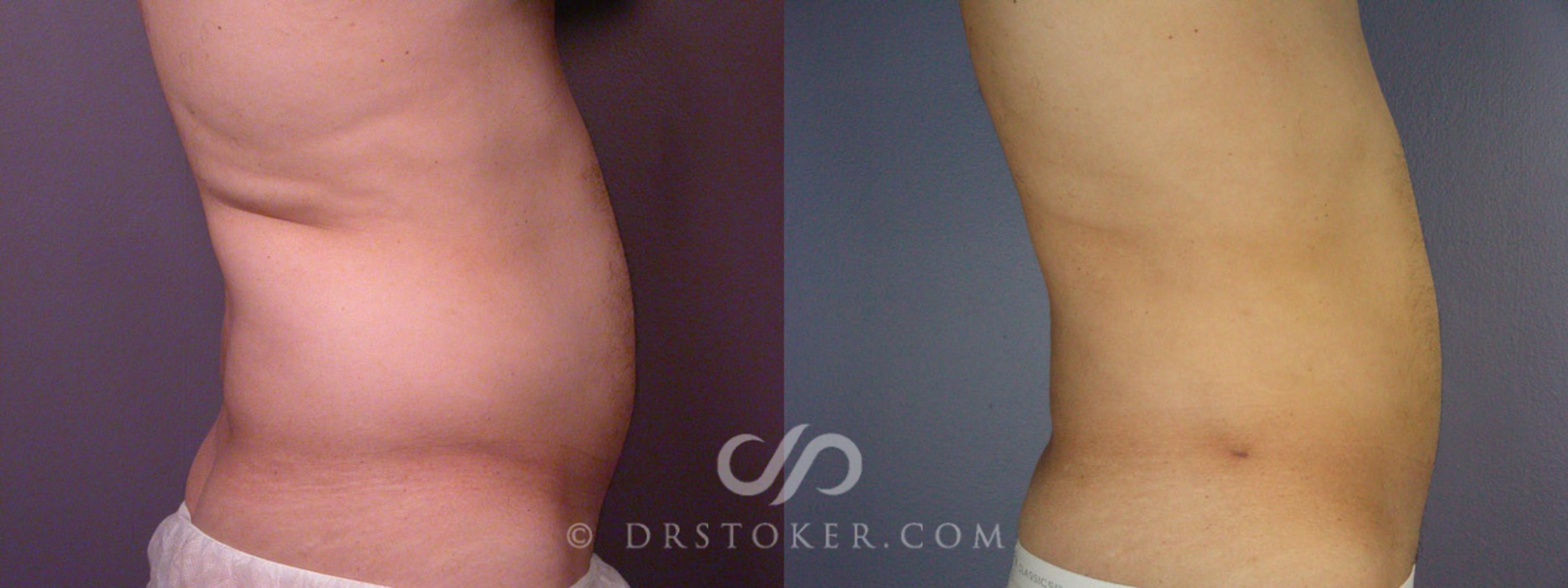 Before & After Liposuction Case 168 View #4 View in Los Angeles, CA