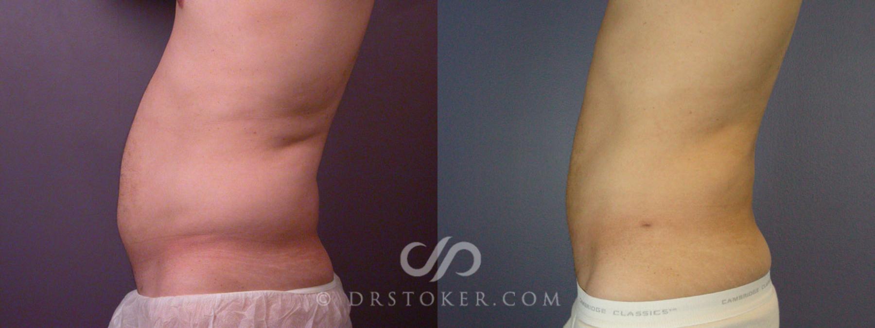 Before & After Liposuction for Men Case 168 View #5 View in Los Angeles, CA