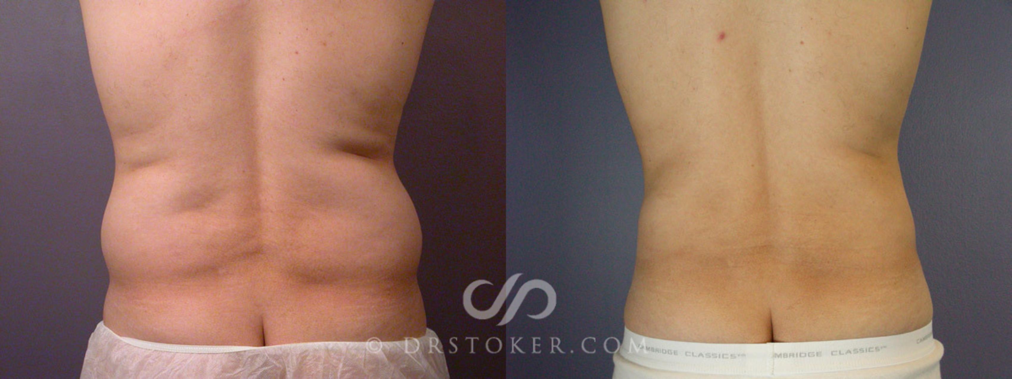 Before & After Liposuction Case 168 View #6 View in Los Angeles, CA