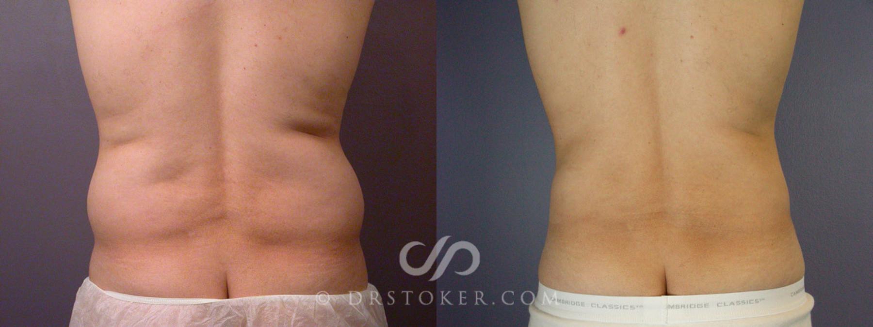 Before & After Liposuction for Men Case 168 View #6 View in Los Angeles, CA