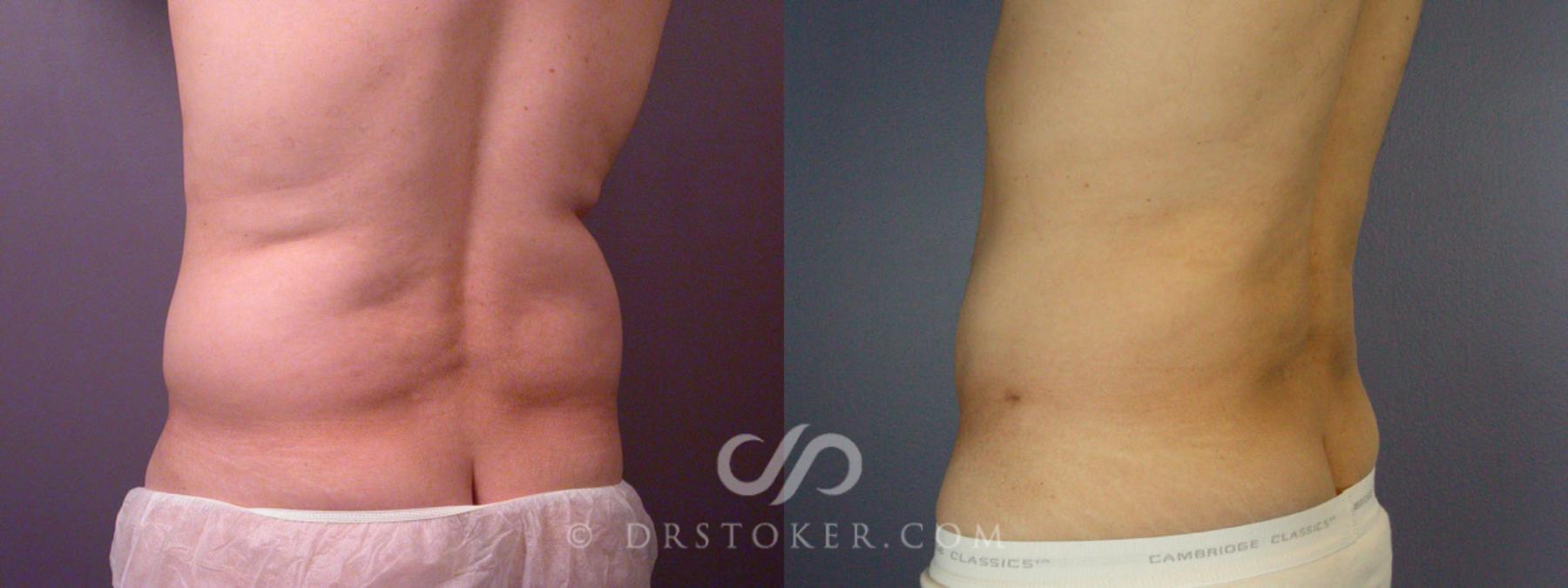 Before & After Liposuction Case 168 View #7 View in Los Angeles, CA