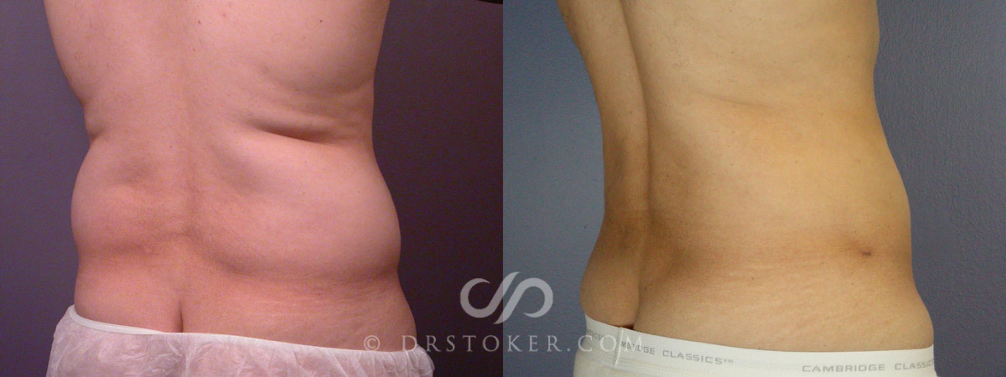 Before & After Liposuction Case 168 View #8 View in Los Angeles, CA