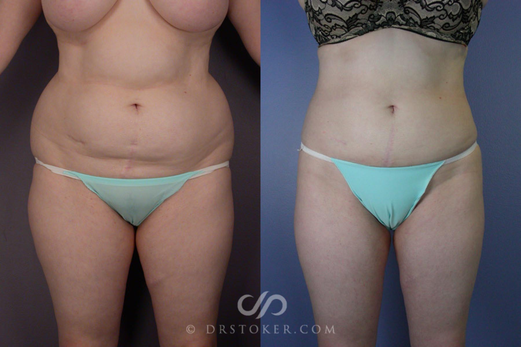 Before & After Liposuction Case 169 View #1 View in Los Angeles, CA