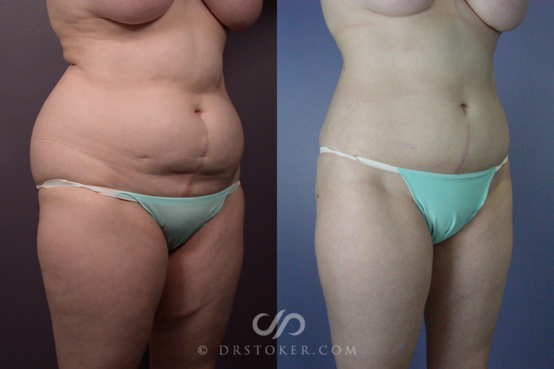 Before & After Liposuction Case 169 View #2 View in Los Angeles, CA