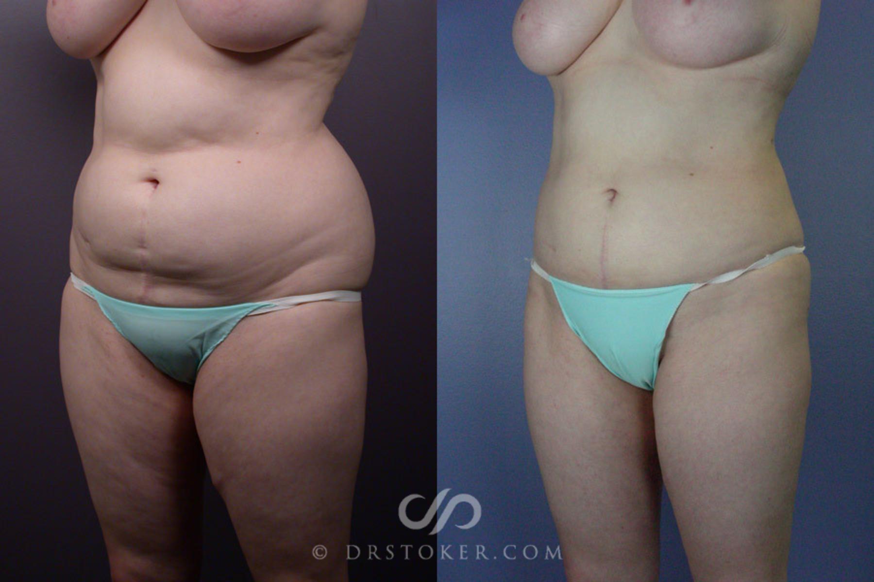 Before & After Liposuction Case 169 View #3 View in Los Angeles, CA