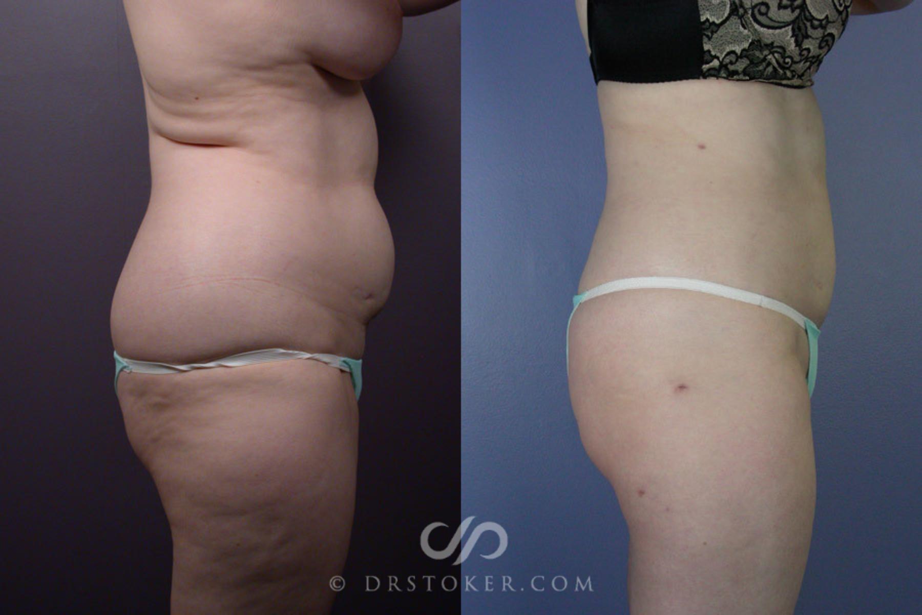 Before & After Liposuction Case 169 View #4 View in Los Angeles, CA