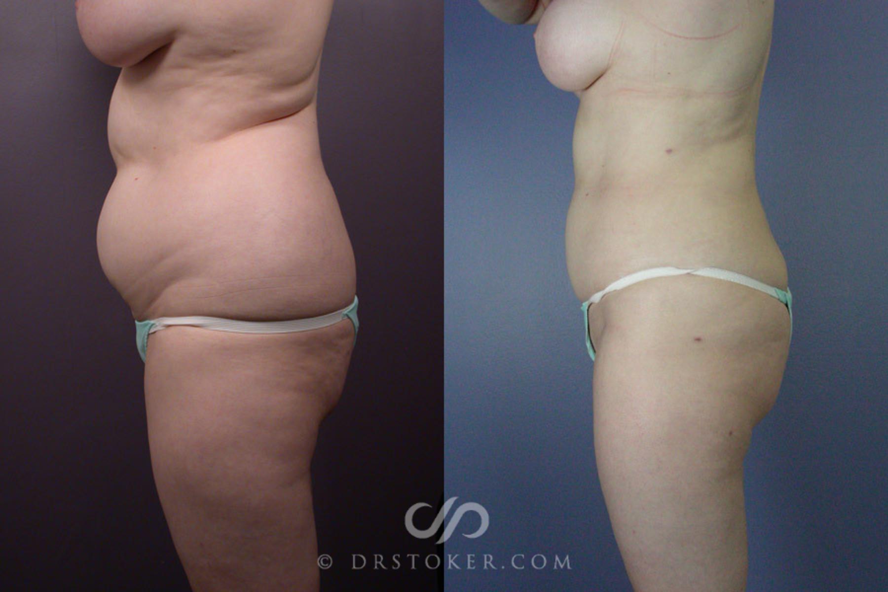 Before & After Liposuction Case 169 View #5 View in Los Angeles, CA