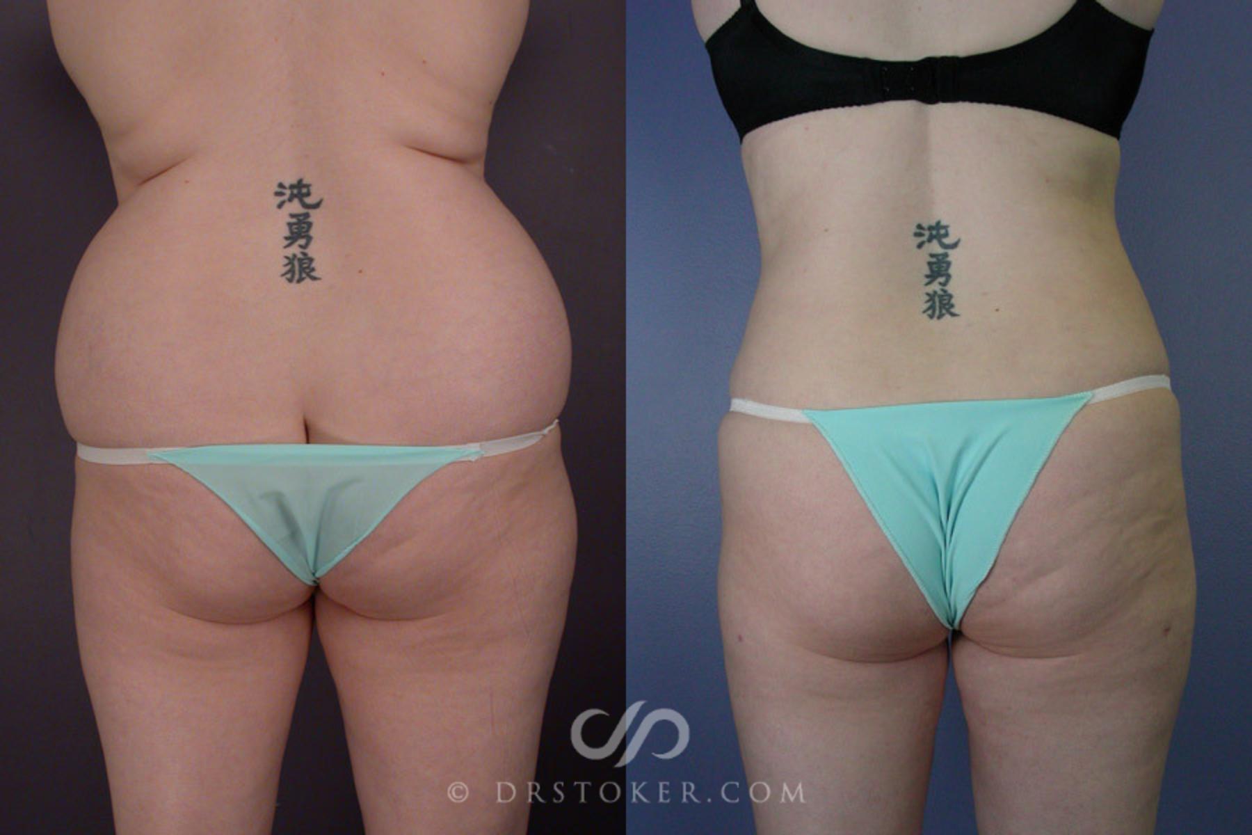 Before & After Liposuction Case 169 View #6 View in Los Angeles, CA