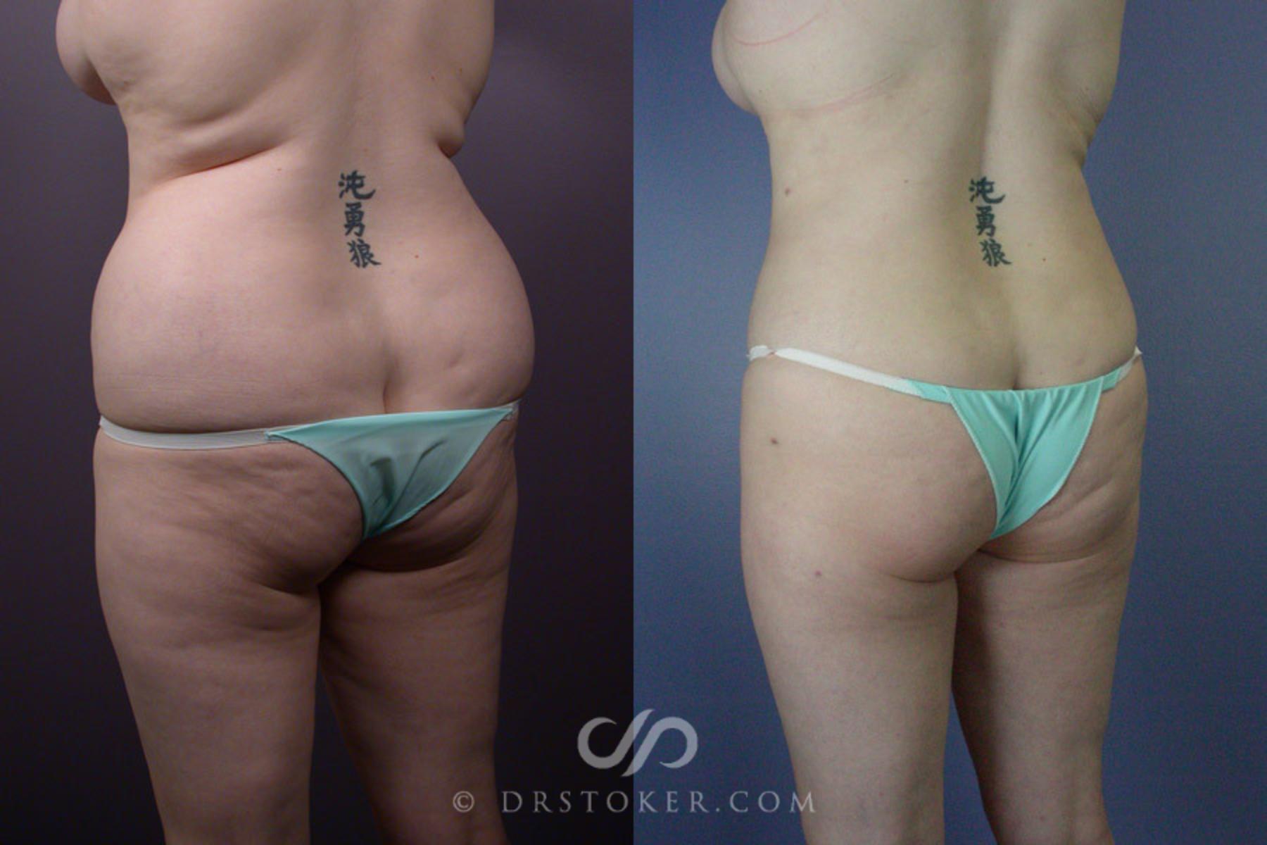 Before & After Liposuction Case 169 View #7 View in Los Angeles, CA
