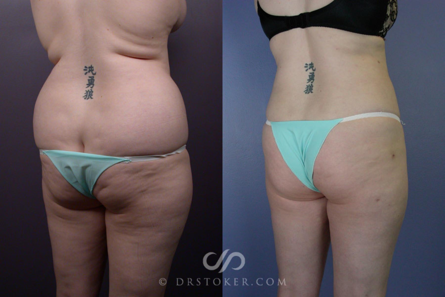 Before & After Liposuction Case 169 View #8 View in Los Angeles, CA