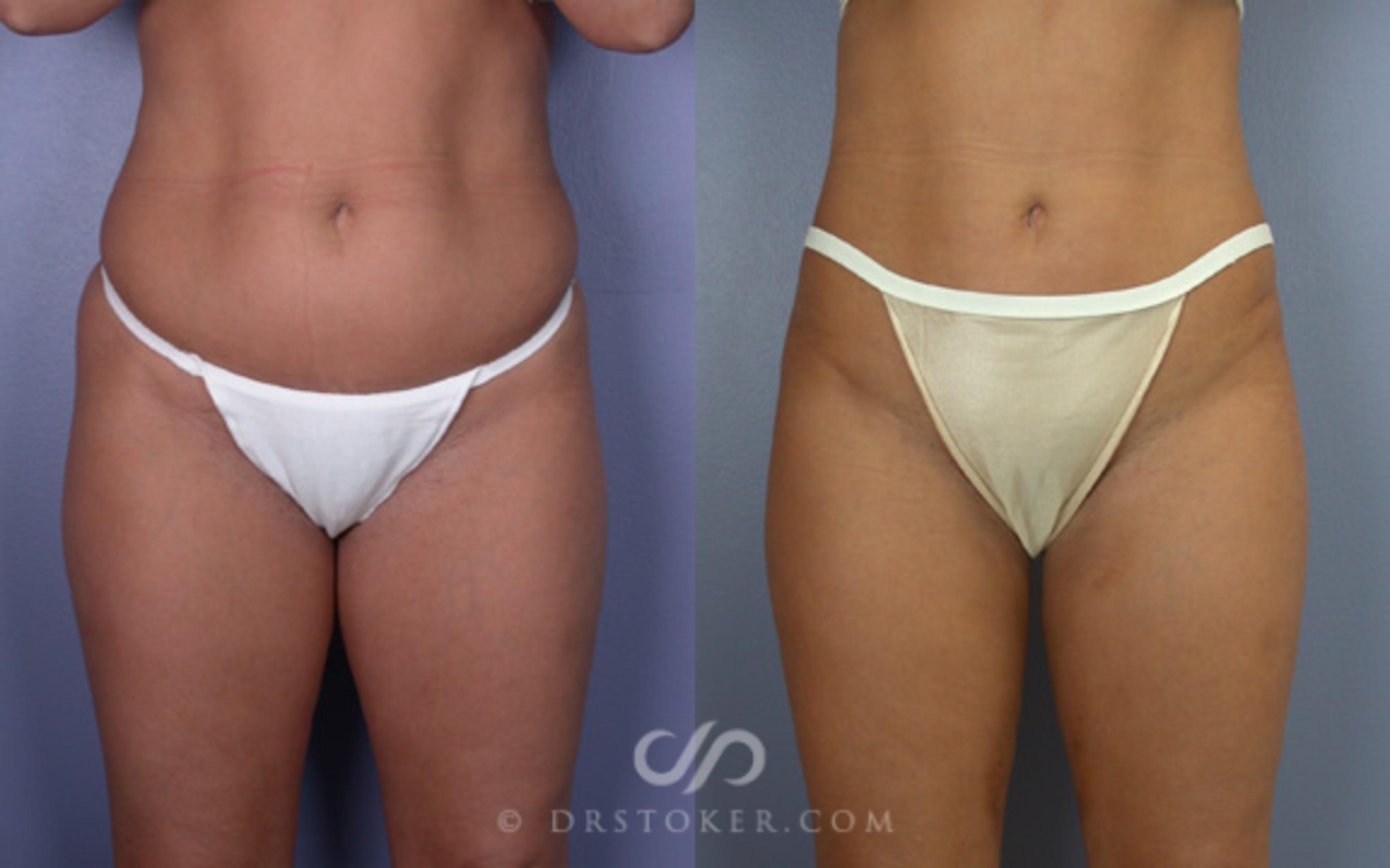 Before & After Liposuction Case 17 View #1 View in Los Angeles, CA