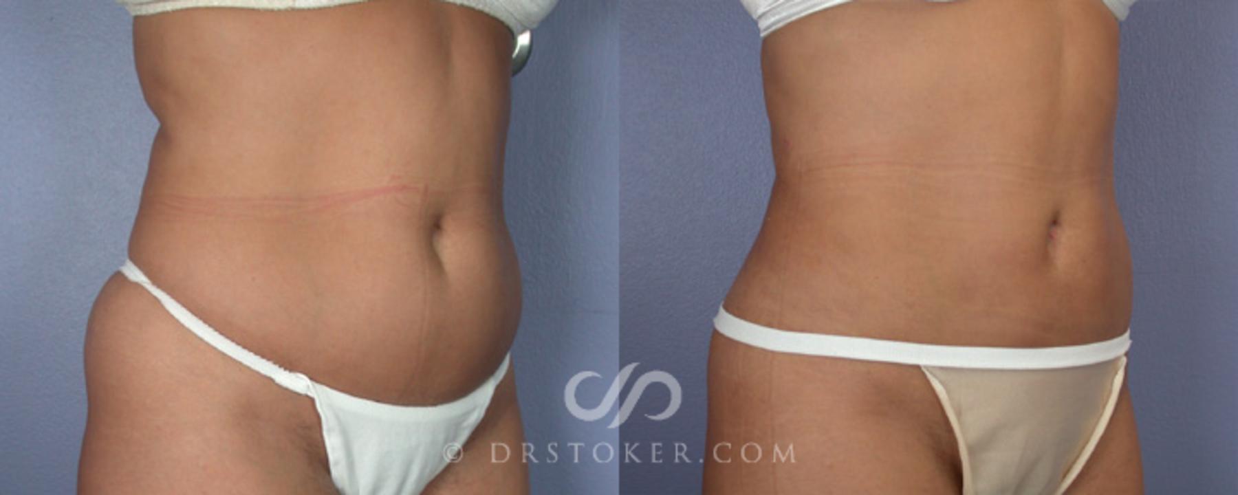 Before & After Liposuction Case 17 View #2 View in Los Angeles, CA