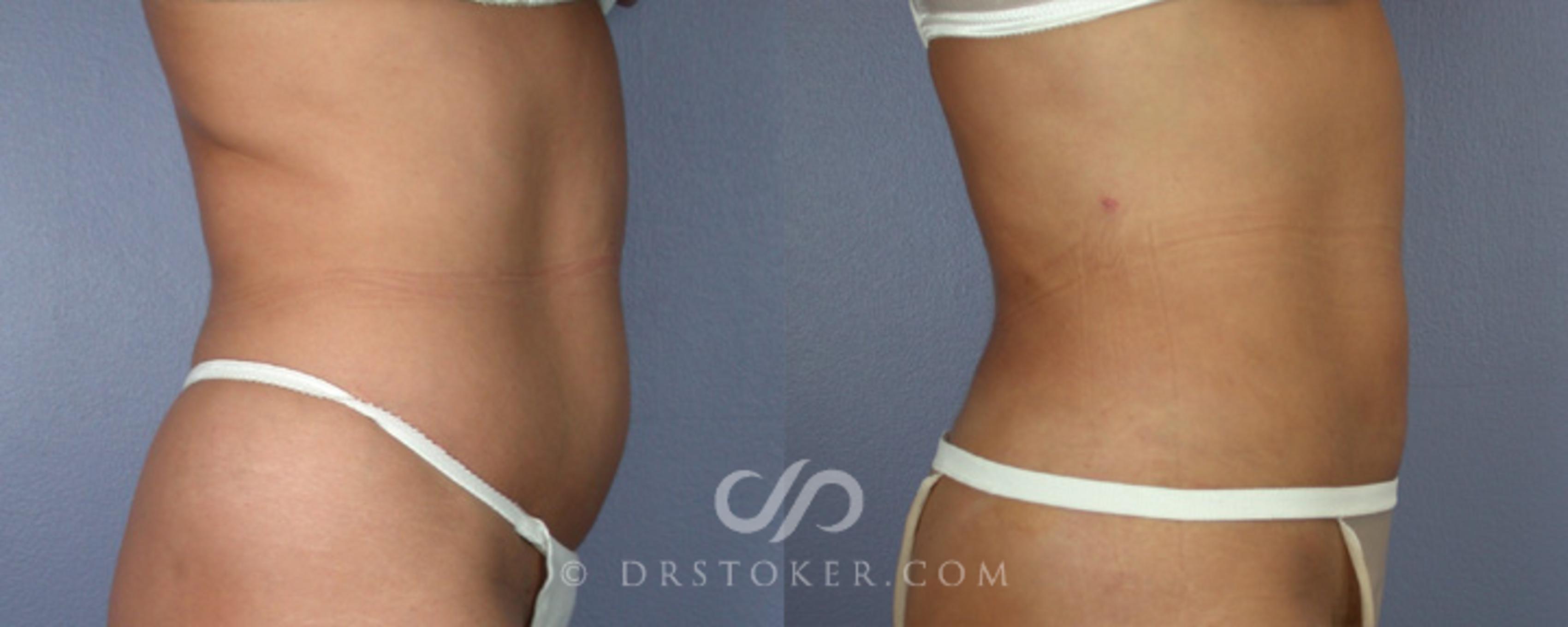 Before & After Liposuction Case 17 View #3 View in Los Angeles, CA