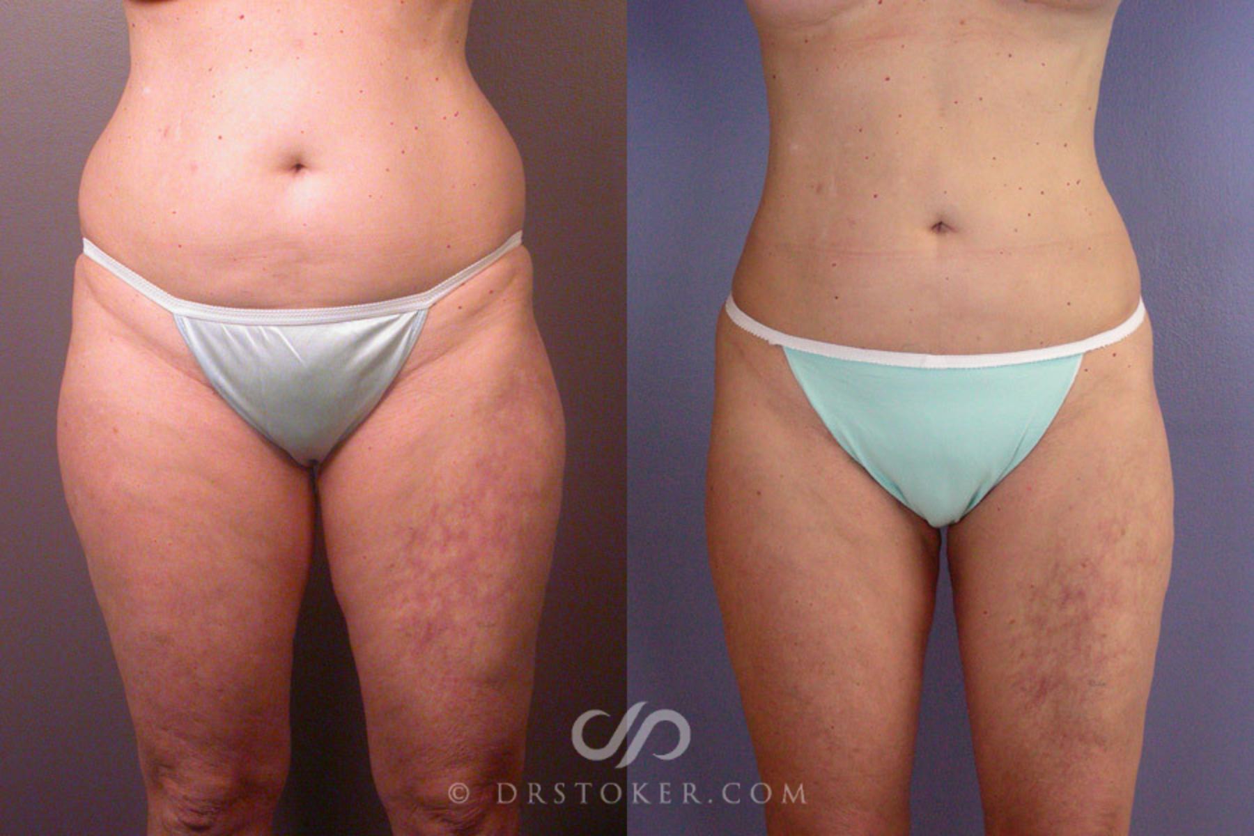 Before & After Liposuction Case 170 View #1 View in Los Angeles, CA