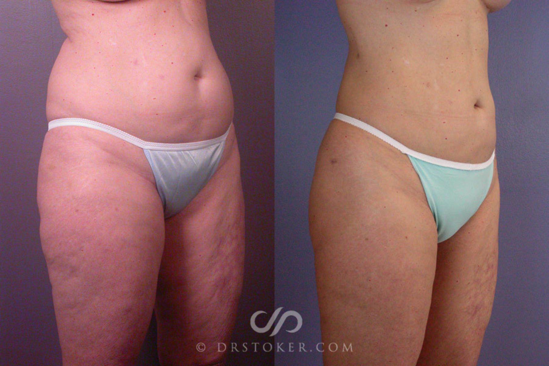 Before & After Liposuction Case 170 View #2 View in Los Angeles, CA