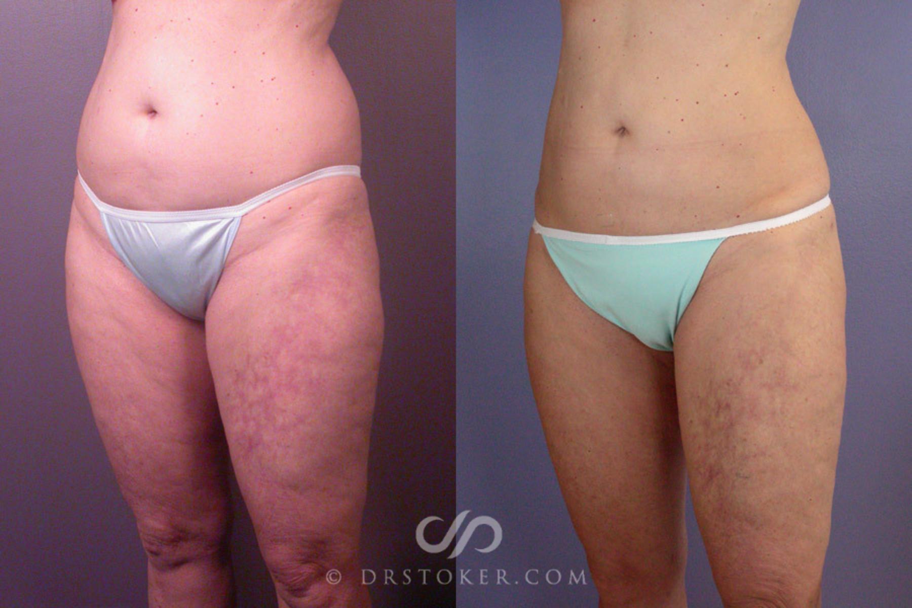 Before & After Liposuction Case 170 View #3 View in Los Angeles, CA