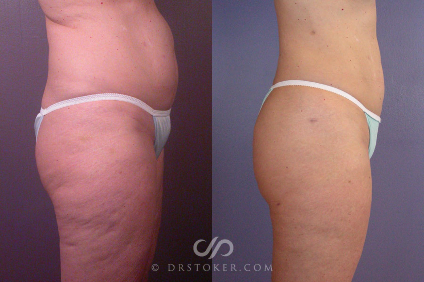 Before & After Liposuction Case 170 View #4 View in Los Angeles, CA