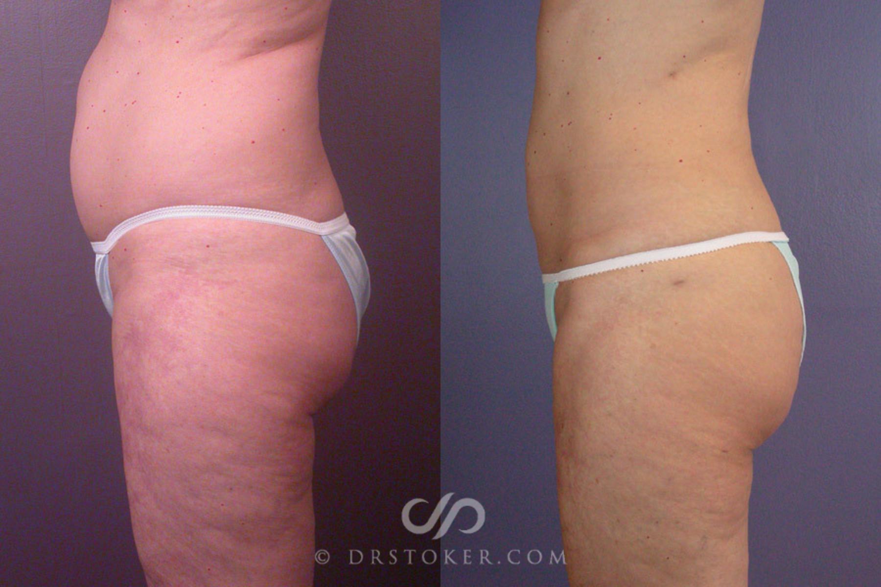 Before & After Liposuction Case 170 View #5 View in Los Angeles, CA
