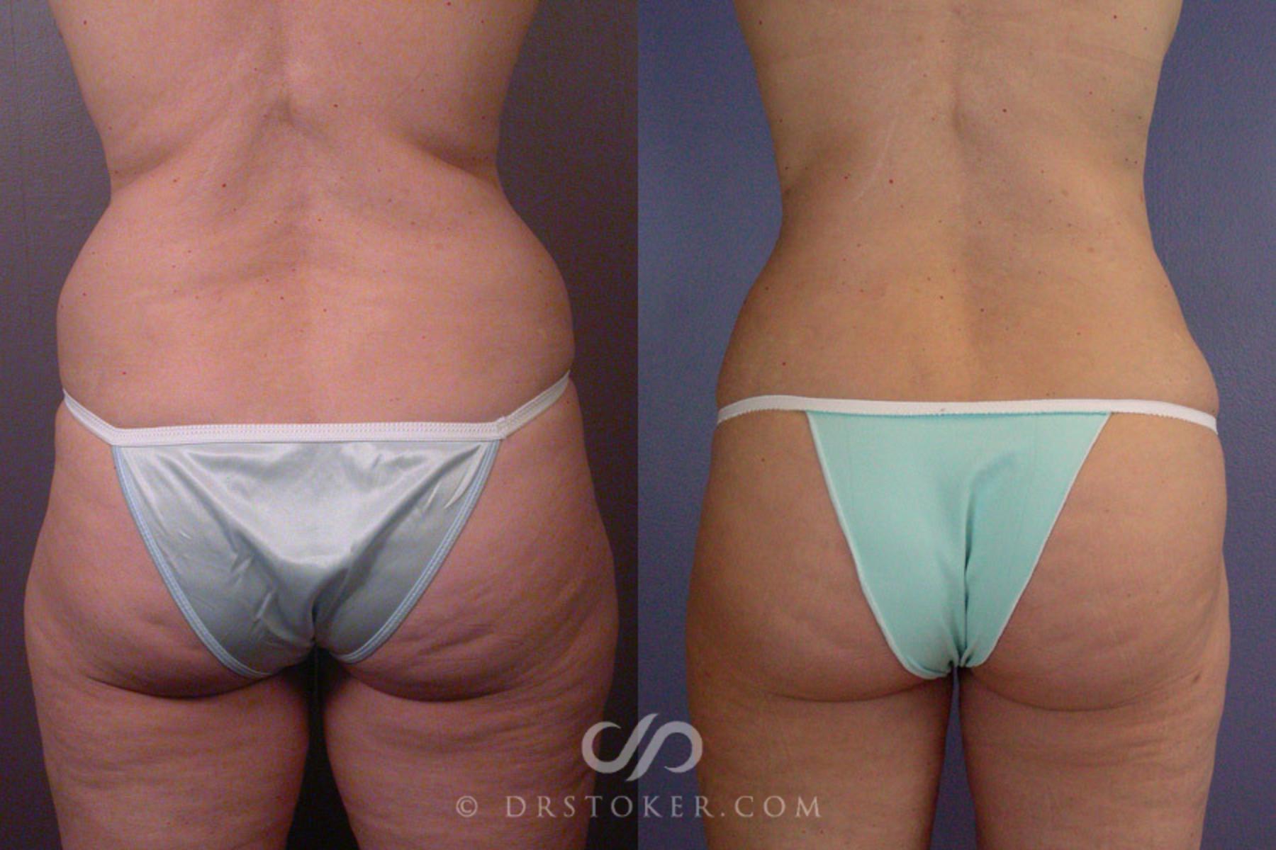 Before & After Liposuction Case 170 View #6 View in Los Angeles, CA