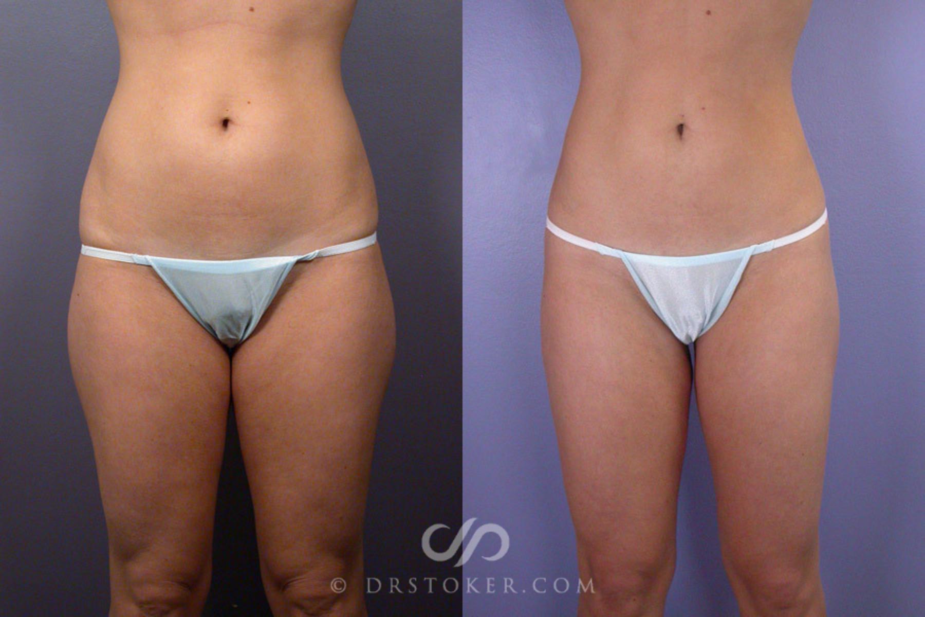 Before & After Liposuction Case 171 View #1 View in Los Angeles, CA