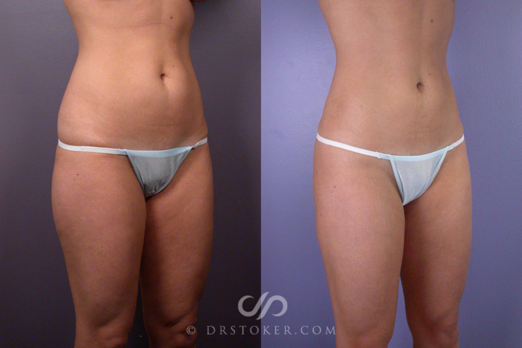Before & After Liposuction Case 171 View #2 View in Los Angeles, CA