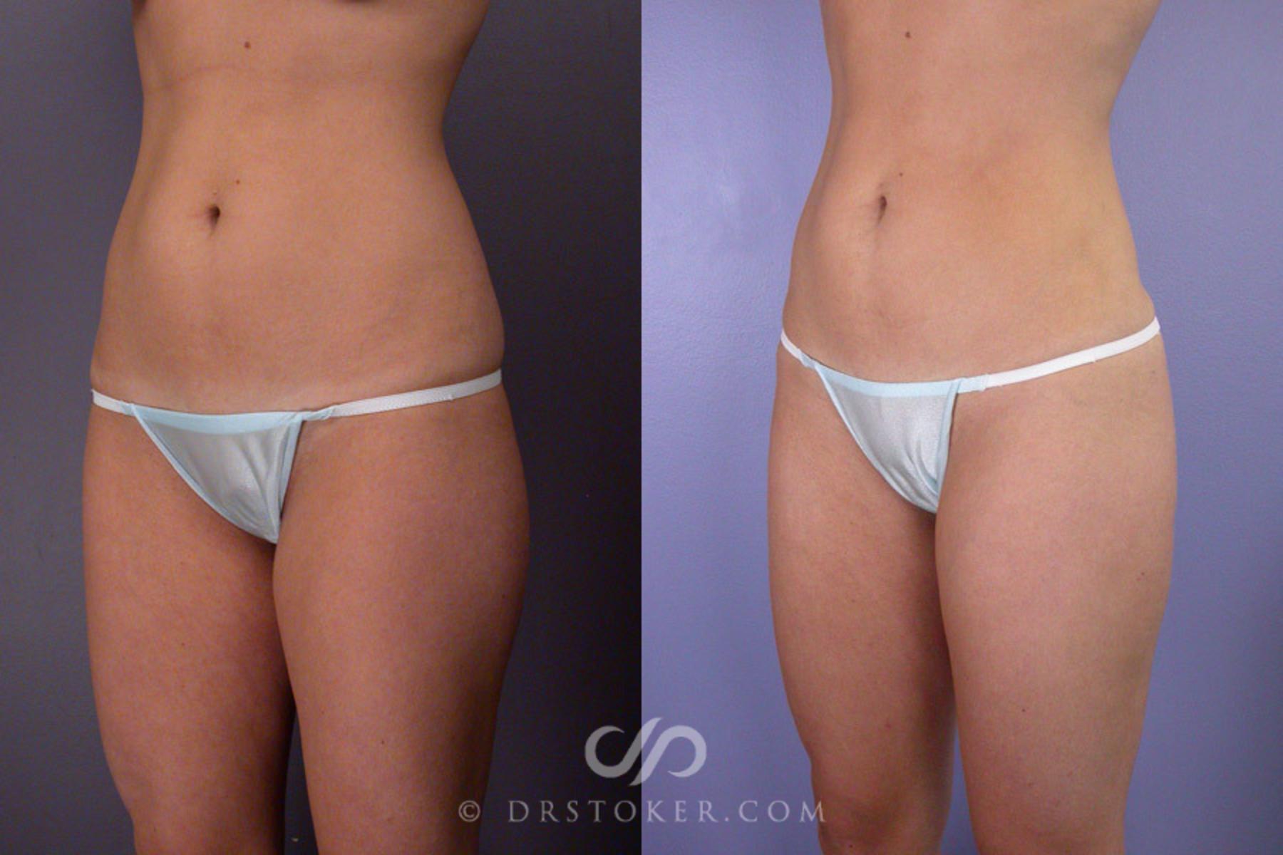 Before & After Liposuction Case 171 View #3 View in Los Angeles, CA