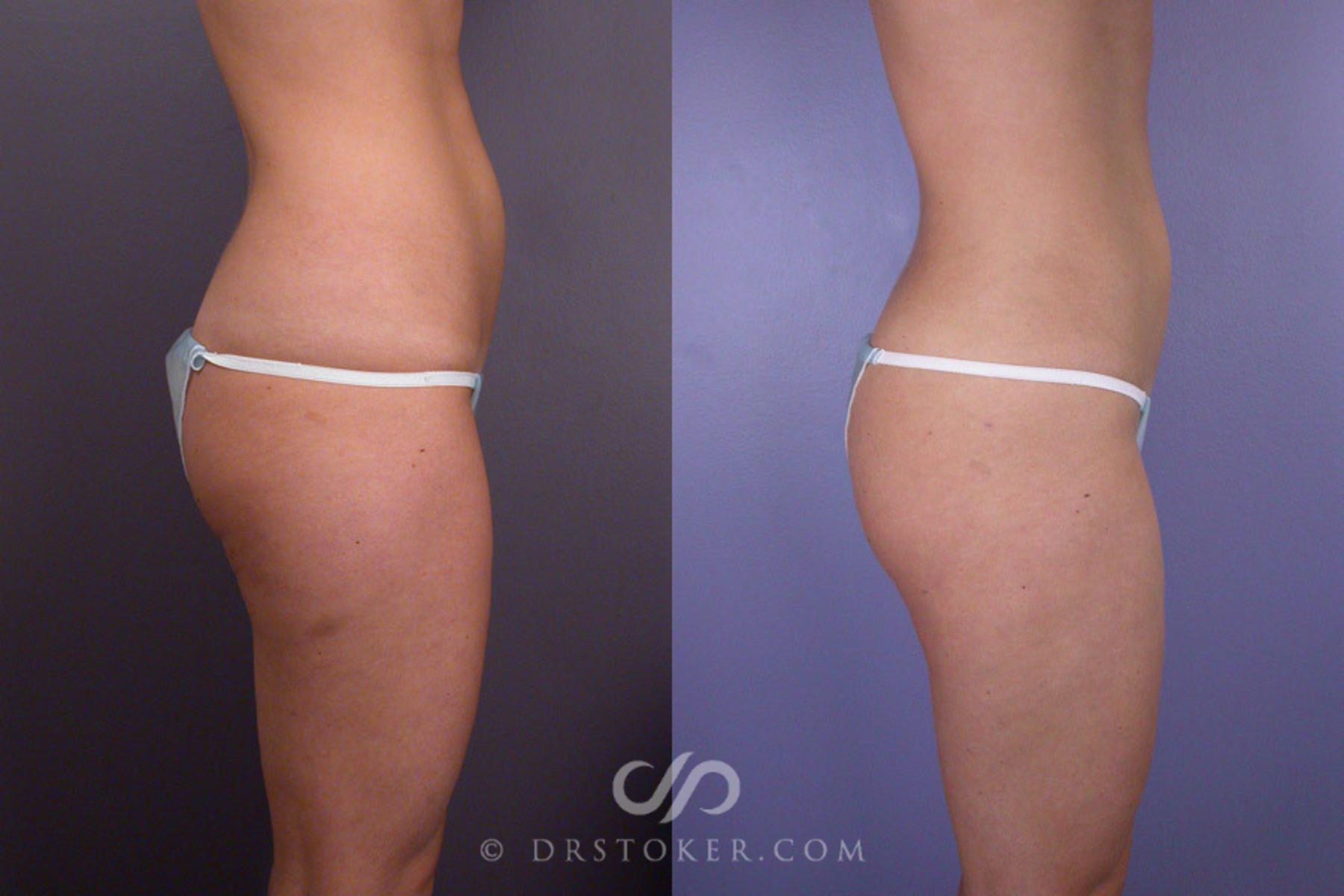 Before & After Liposuction Case 171 View #4 View in Los Angeles, CA