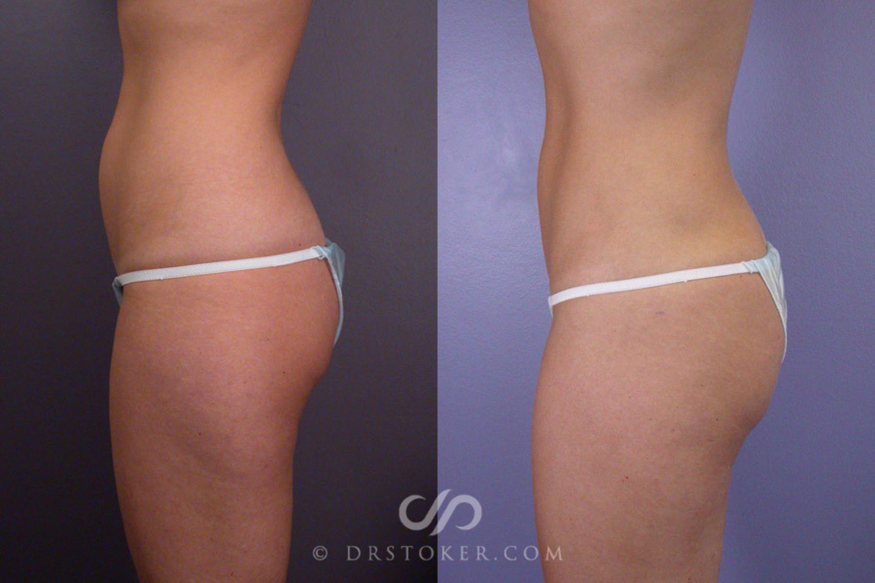 Before & After Liposuction Case 171 View #5 View in Los Angeles, CA
