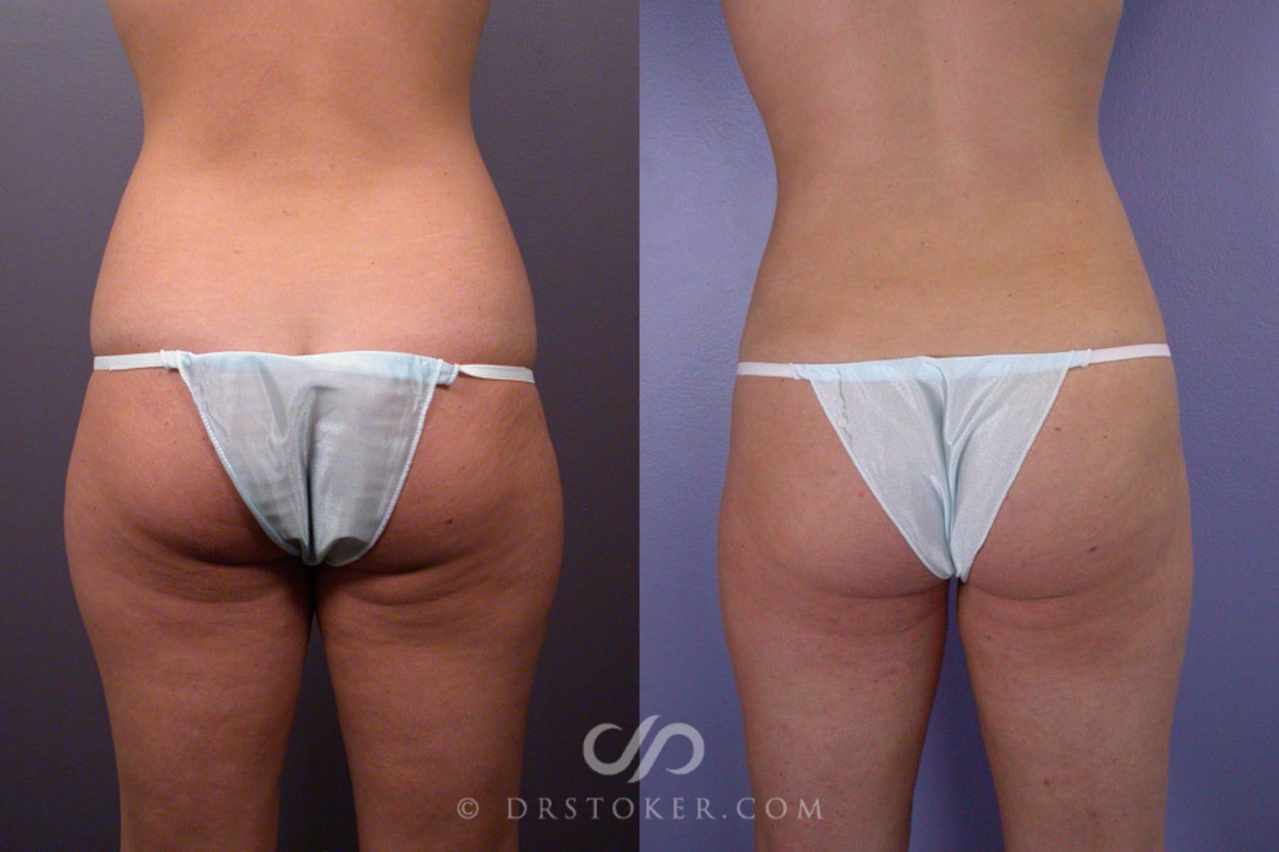 Before & After Liposuction Case 171 View #6 View in Los Angeles, CA
