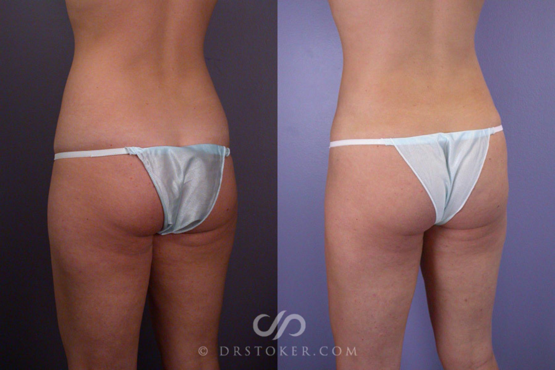 Before & After Liposuction Case 171 View #7 View in Los Angeles, CA