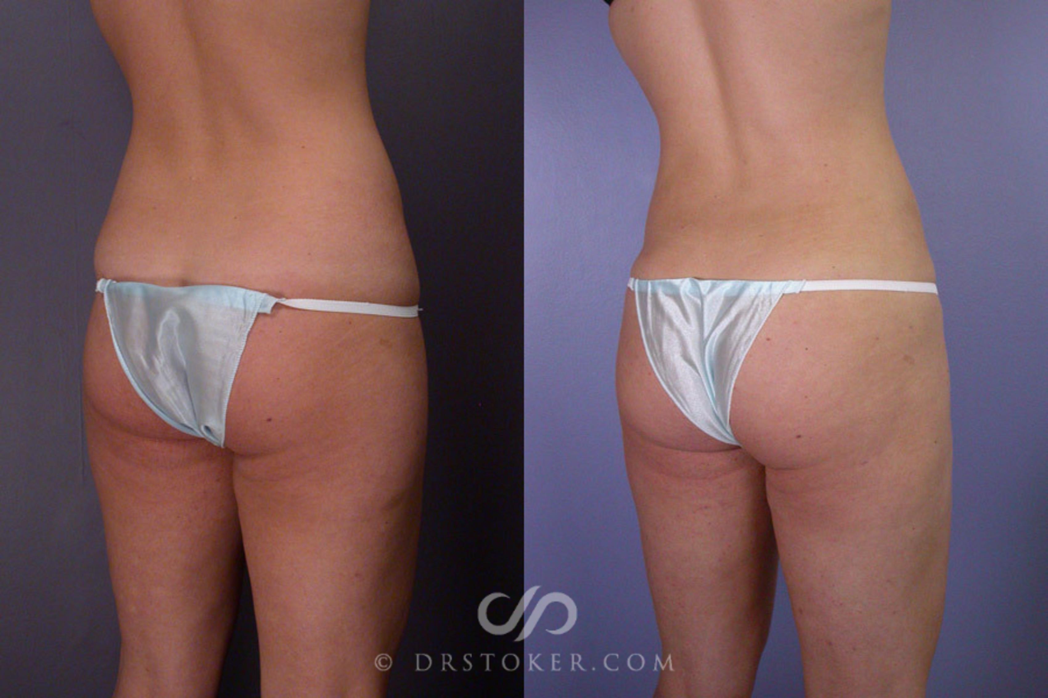 Before & After Liposuction Case 171 View #8 View in Los Angeles, CA