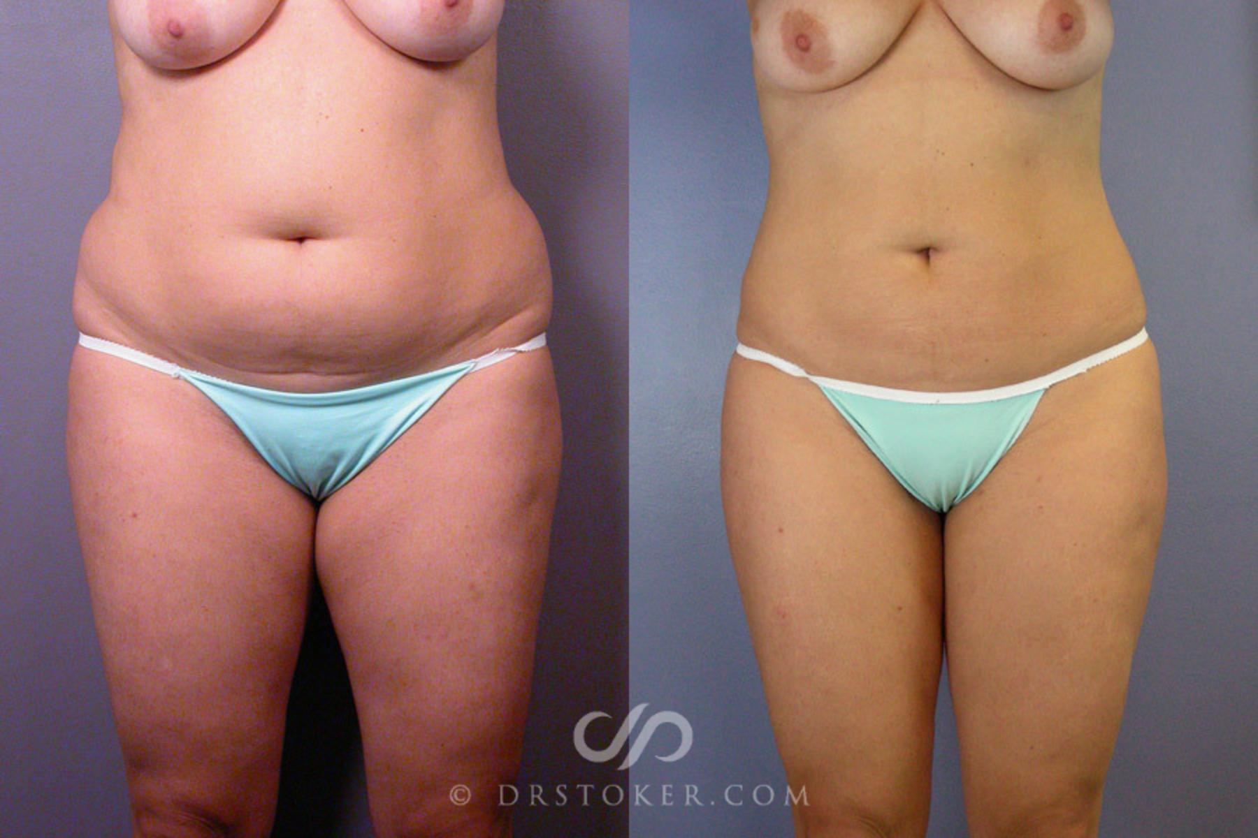Before & After Liposuction Case 172 View #1 View in Los Angeles, CA