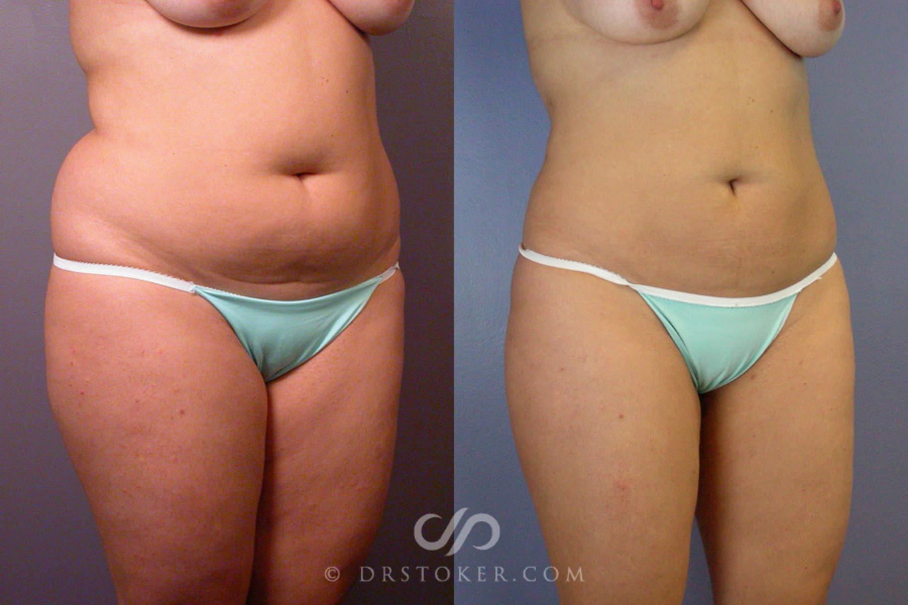 Before & After Liposuction Case 172 View #2 View in Los Angeles, CA