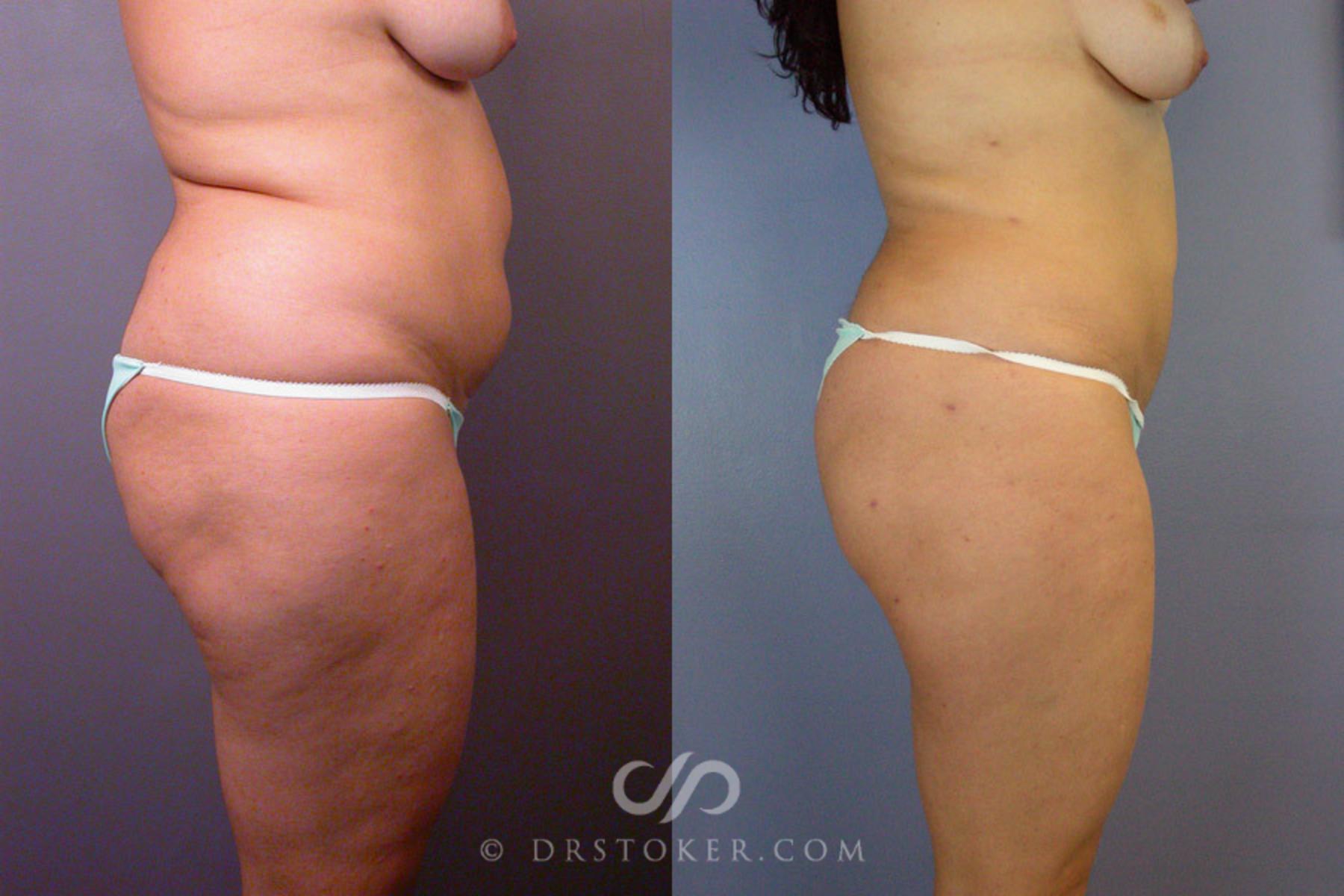 Before & After Liposuction Case 172 View #4 View in Los Angeles, CA