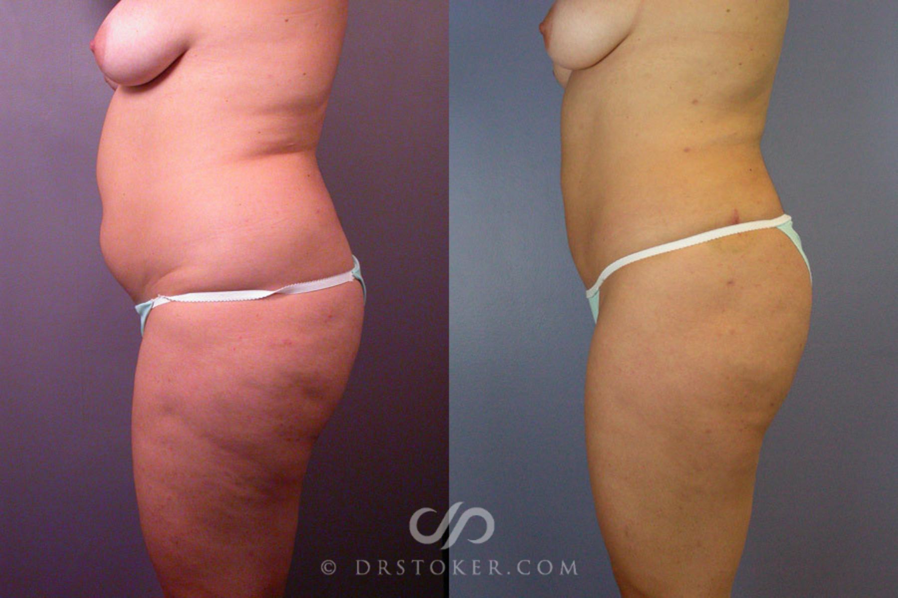 Before & After Liposuction Case 172 View #5 View in Los Angeles, CA