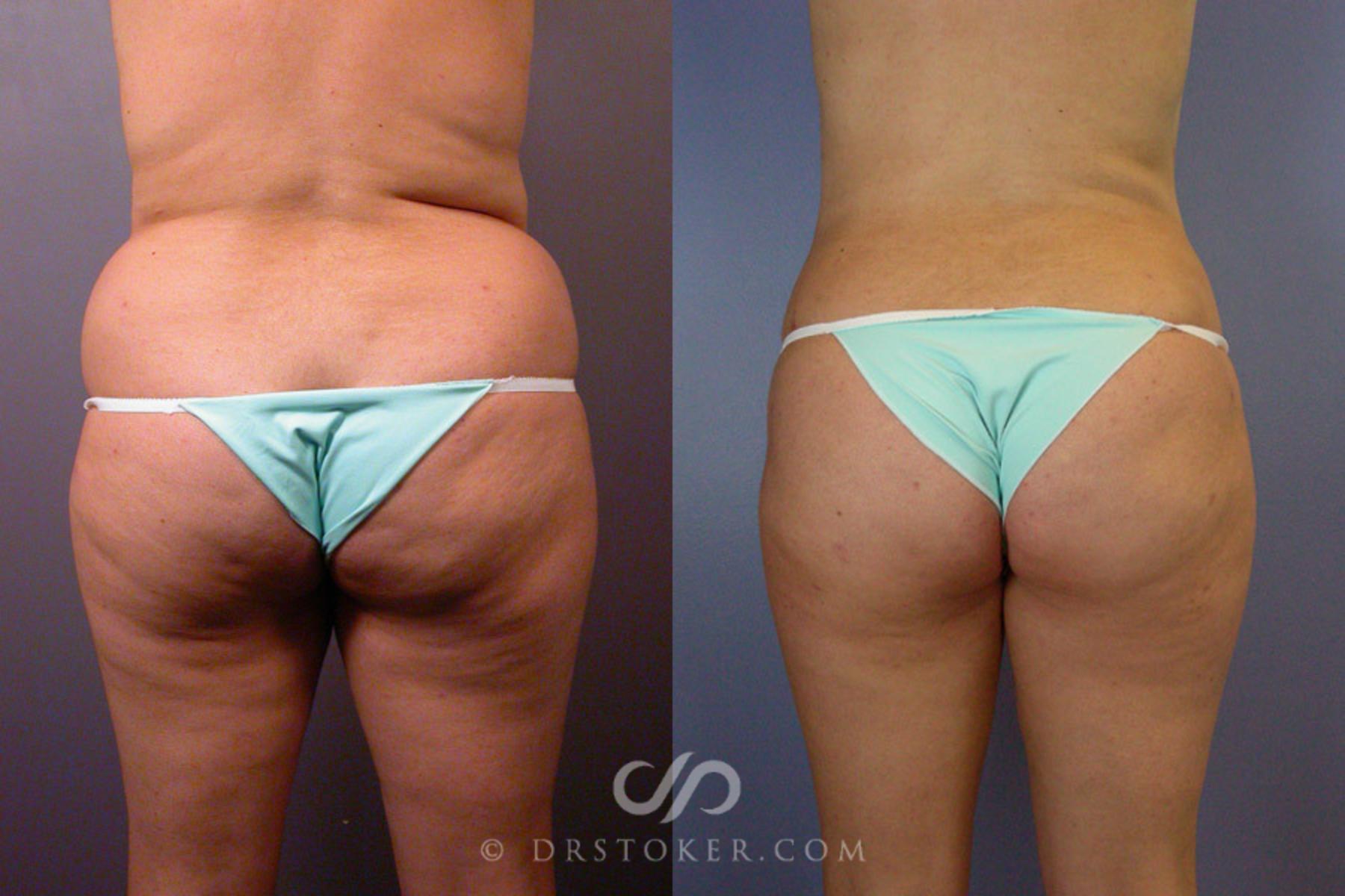 Before & After Liposuction Case 172 View #6 View in Los Angeles, CA