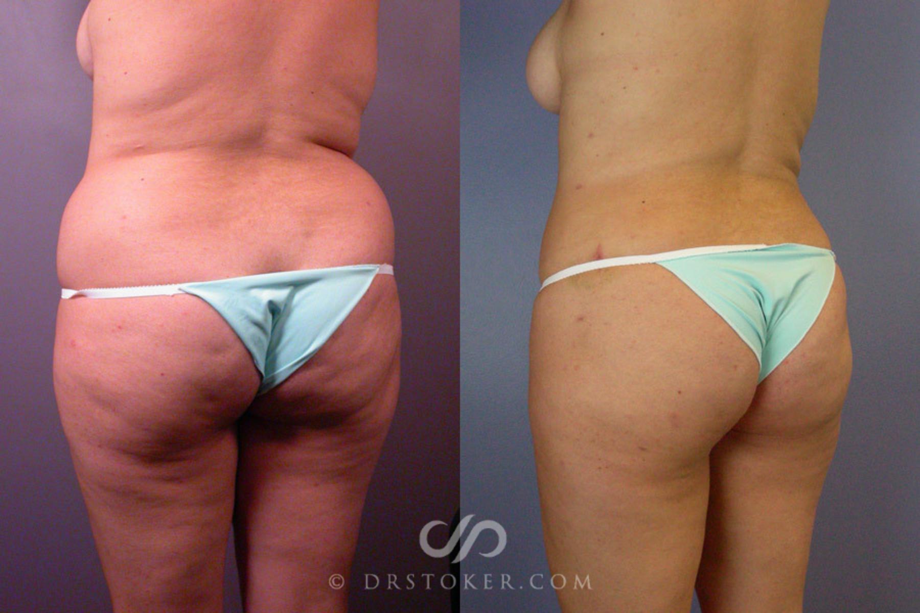 Before & After Liposuction Case 172 View #7 View in Los Angeles, CA