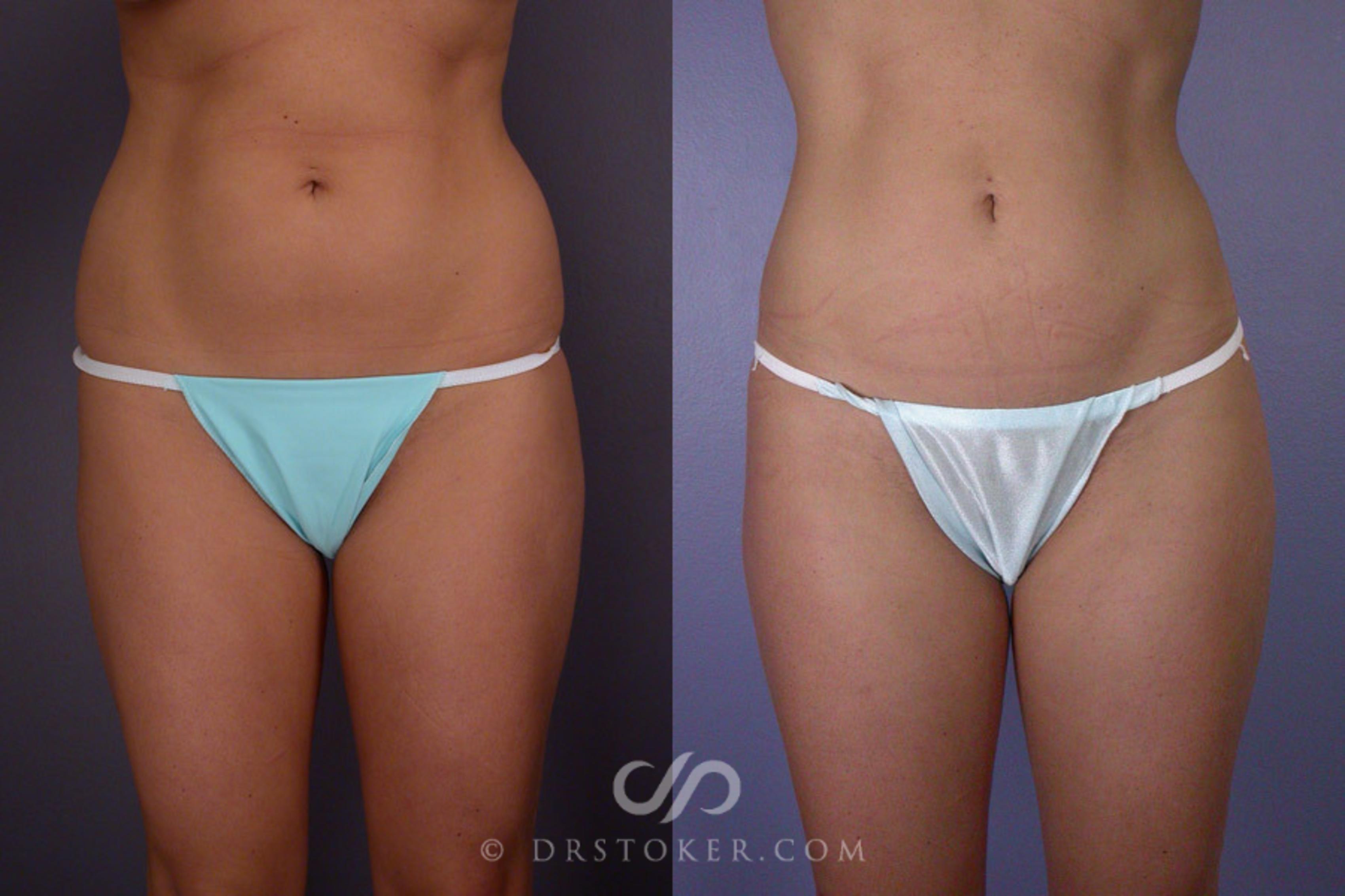 Before & After Liposuction Case 173 View #1 View in Los Angeles, CA