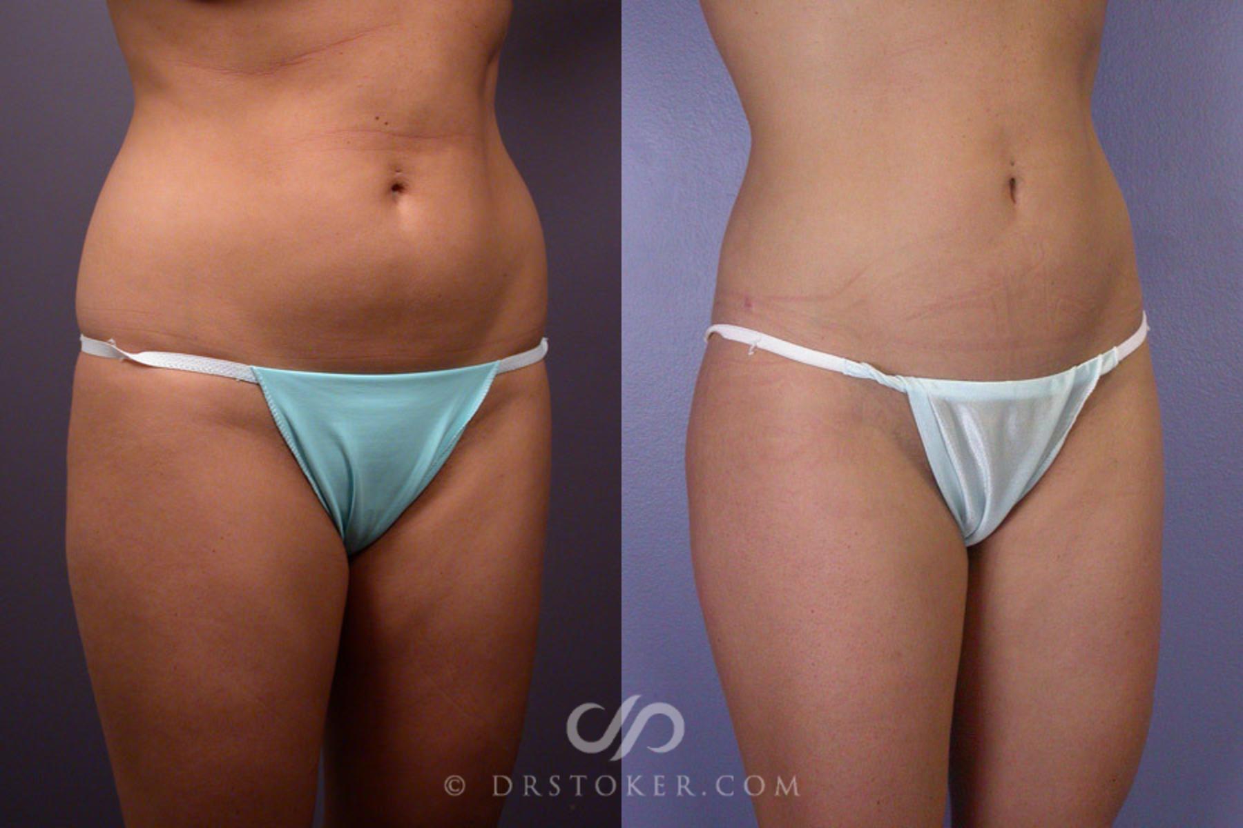 Before & After Liposuction Case 173 View #2 View in Los Angeles, CA