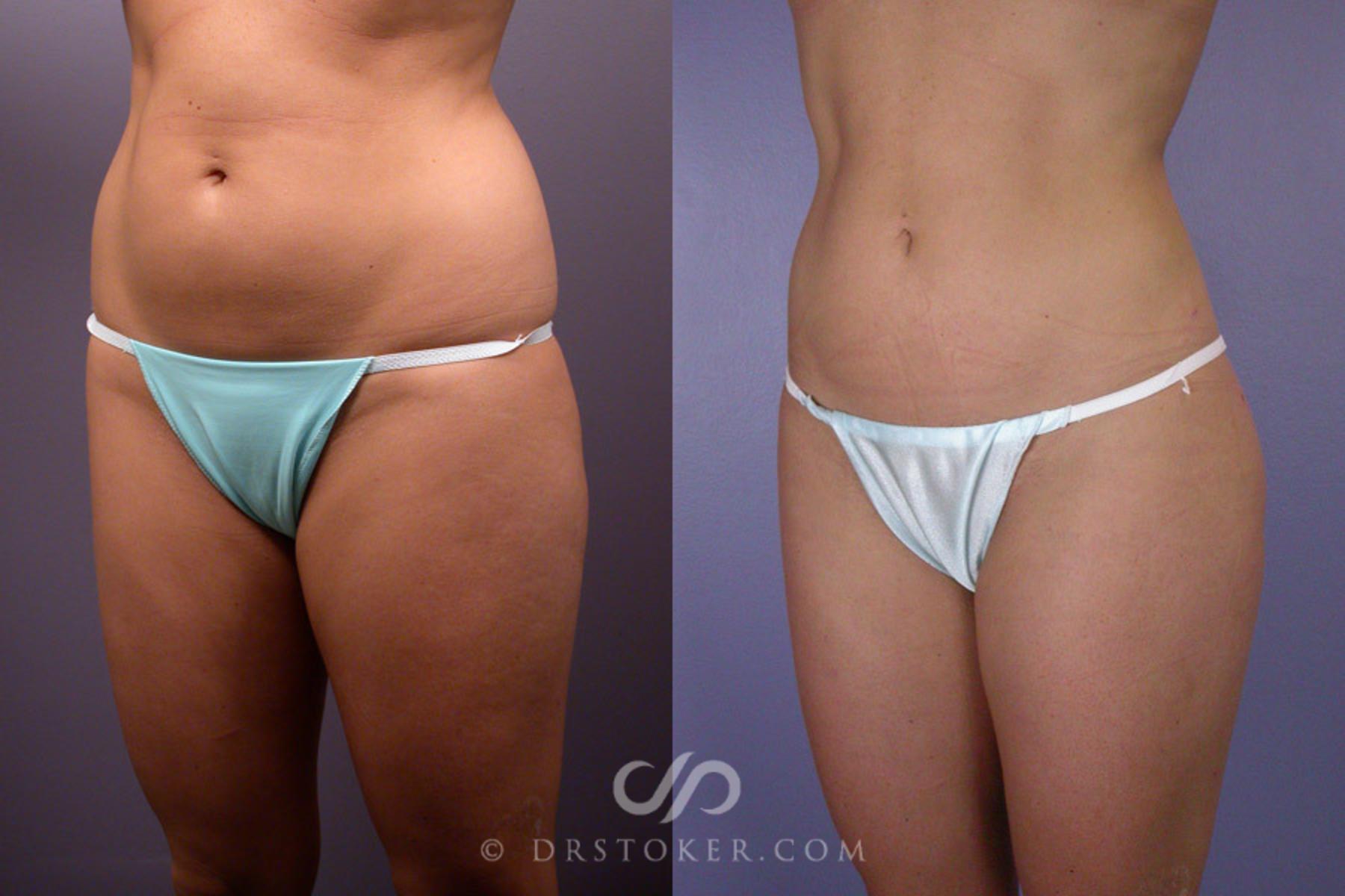 Before & After Liposuction Case 173 View #3 View in Los Angeles, CA
